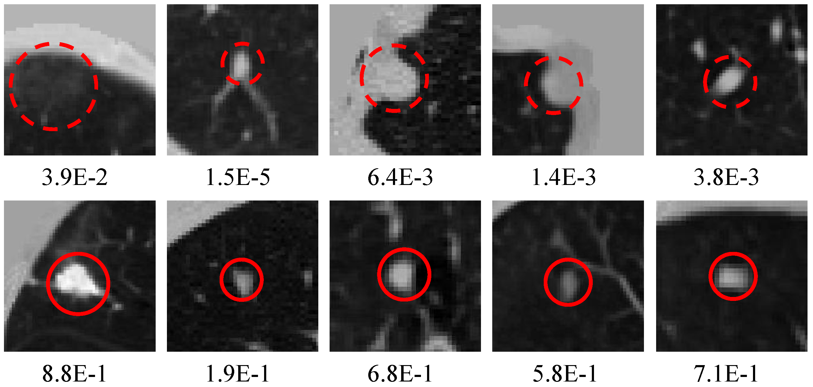 Diagnostics Free FullText A Lower False Positive Pulmonary Nodule