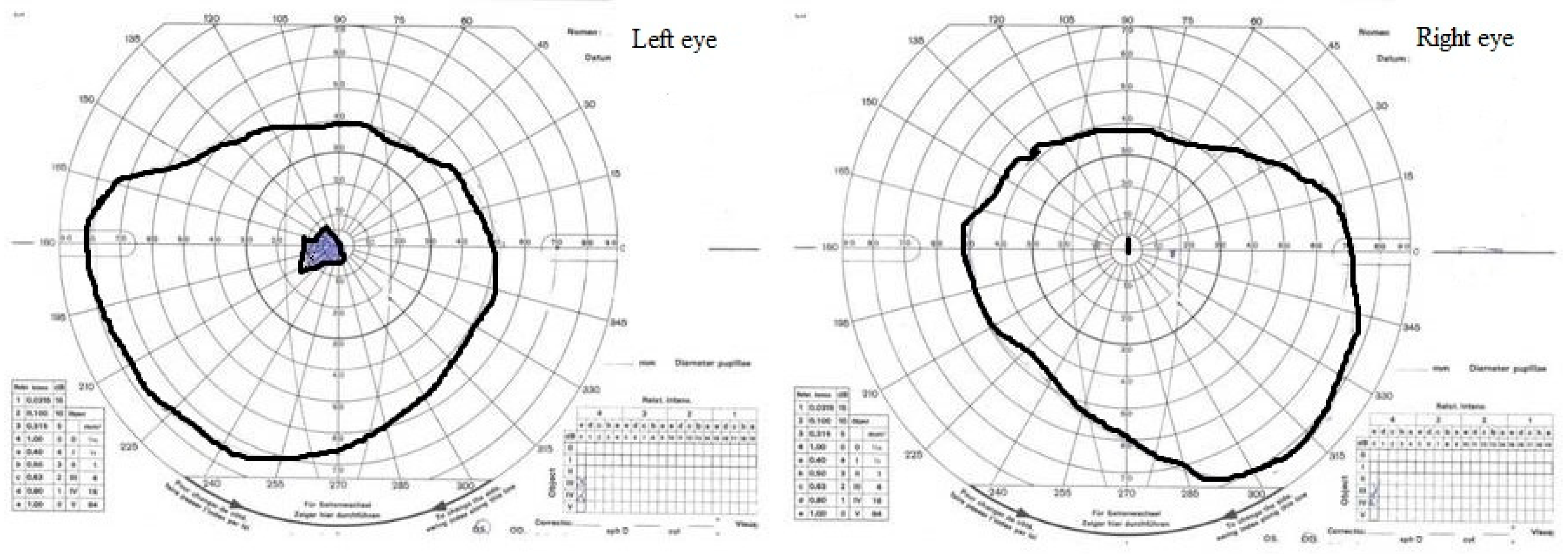 scotoma evolution optic neuritis