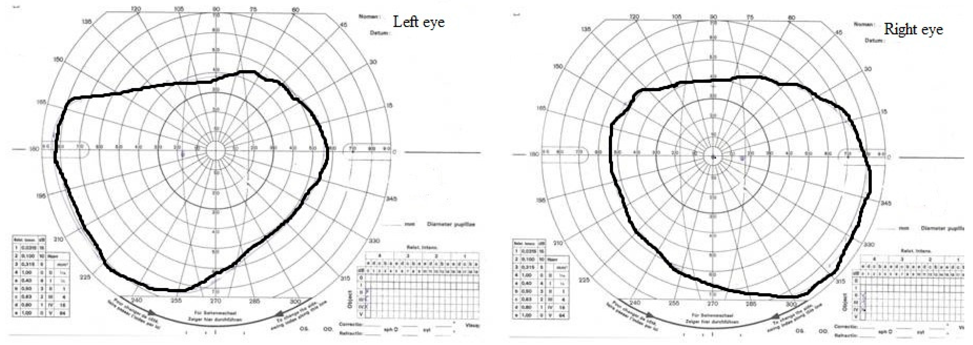 scotoma evolution optic neuritis