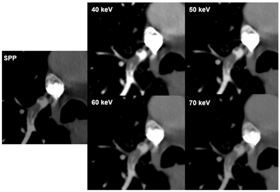 Impact of Photon Counting Detector CT Derived Virtual Monoenergetic ...