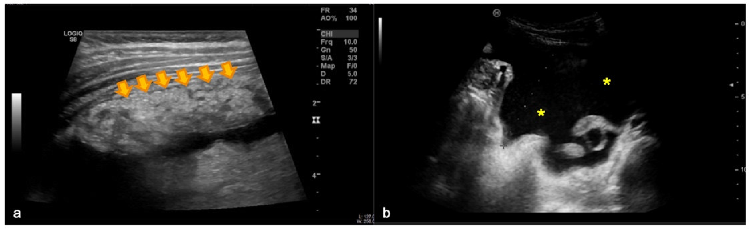 Diagnostics Free FullText The Omental Cake Sign in Pediatric
