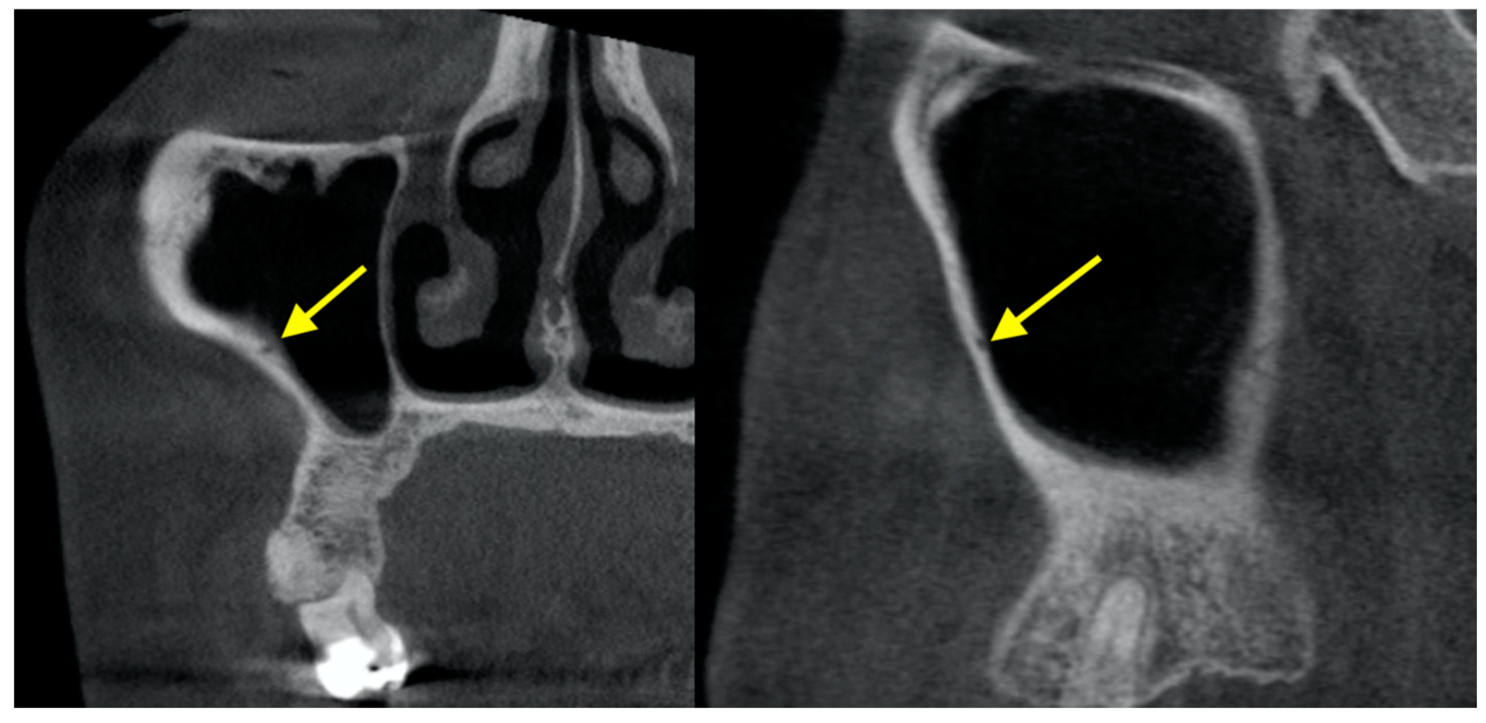 Maxillary Sinus X Ray