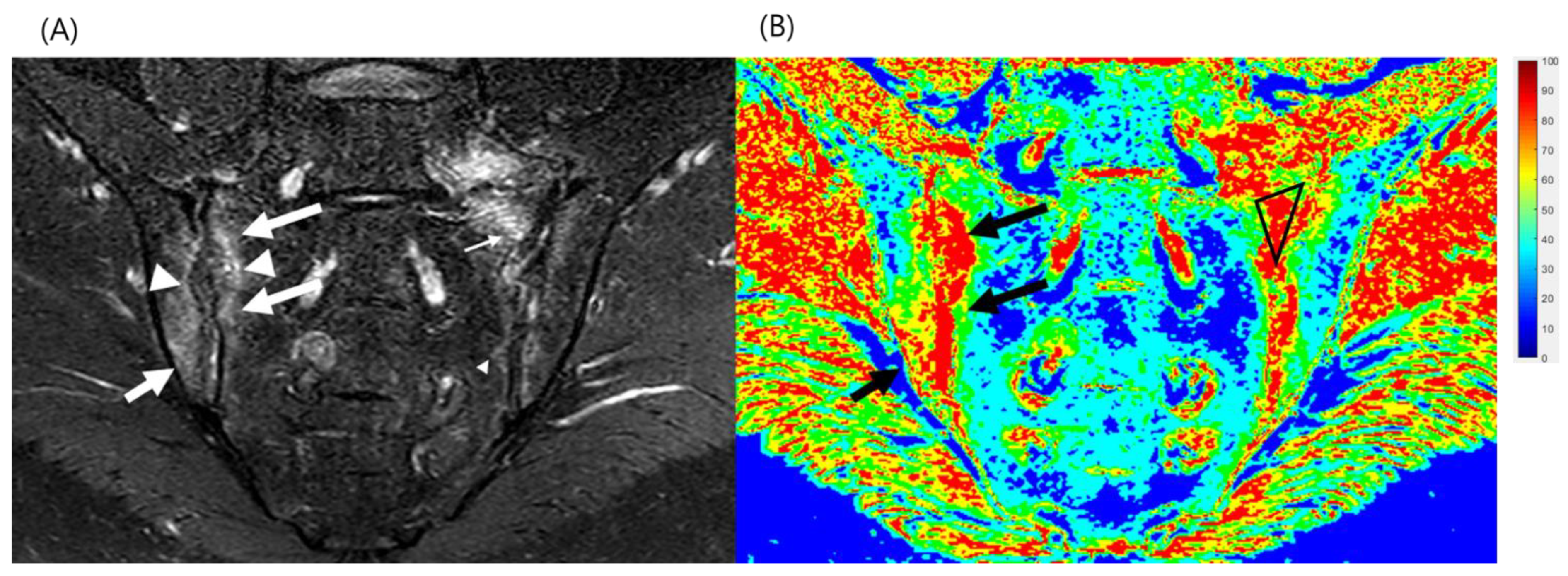 Mean Ankylosing Spondylitis Disease Activity Score with C‐reactive