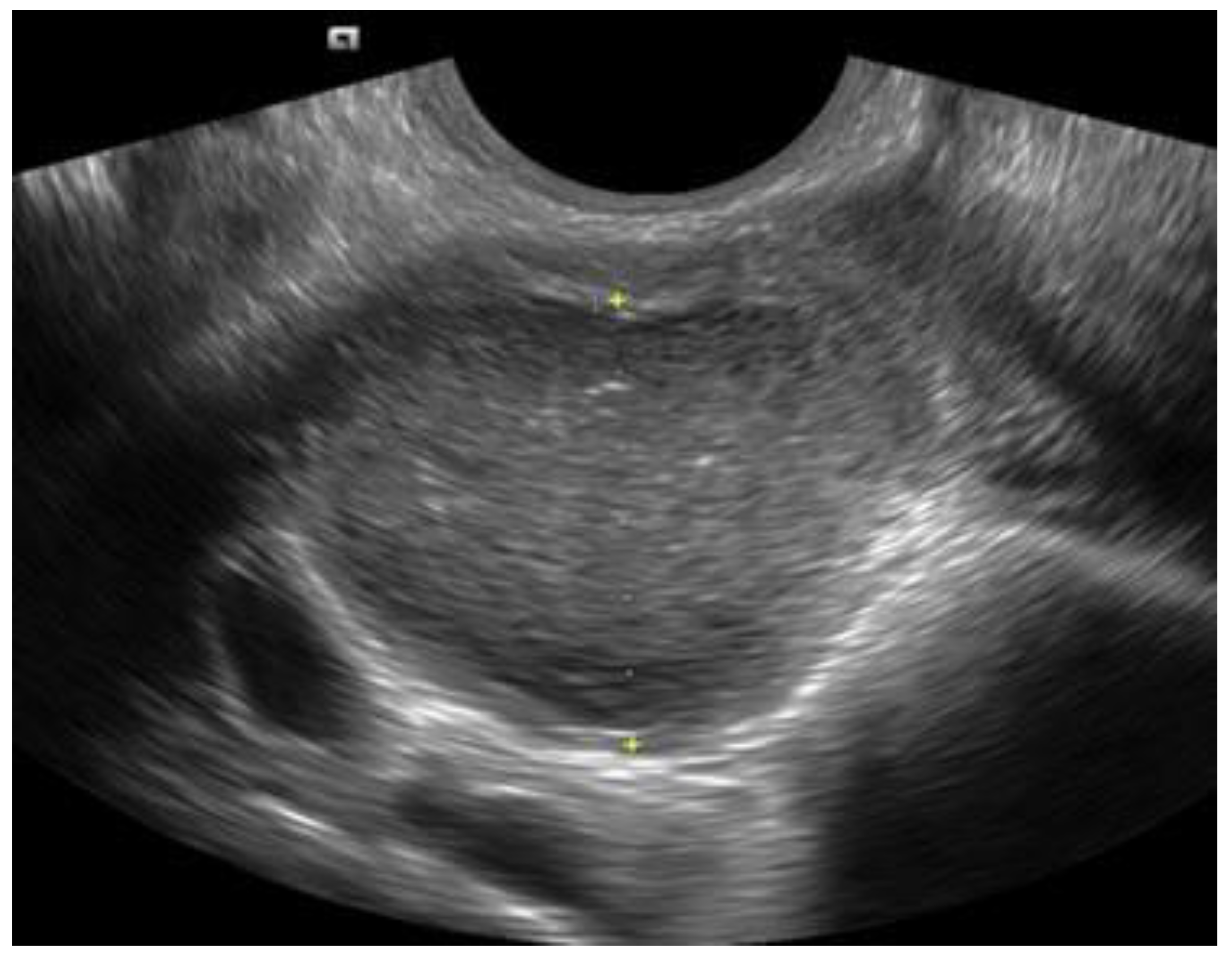 Diagnostics | Free Full-Text | Ultrasound in the and of Endometriosis&mdash;An Overview: Why, and When
