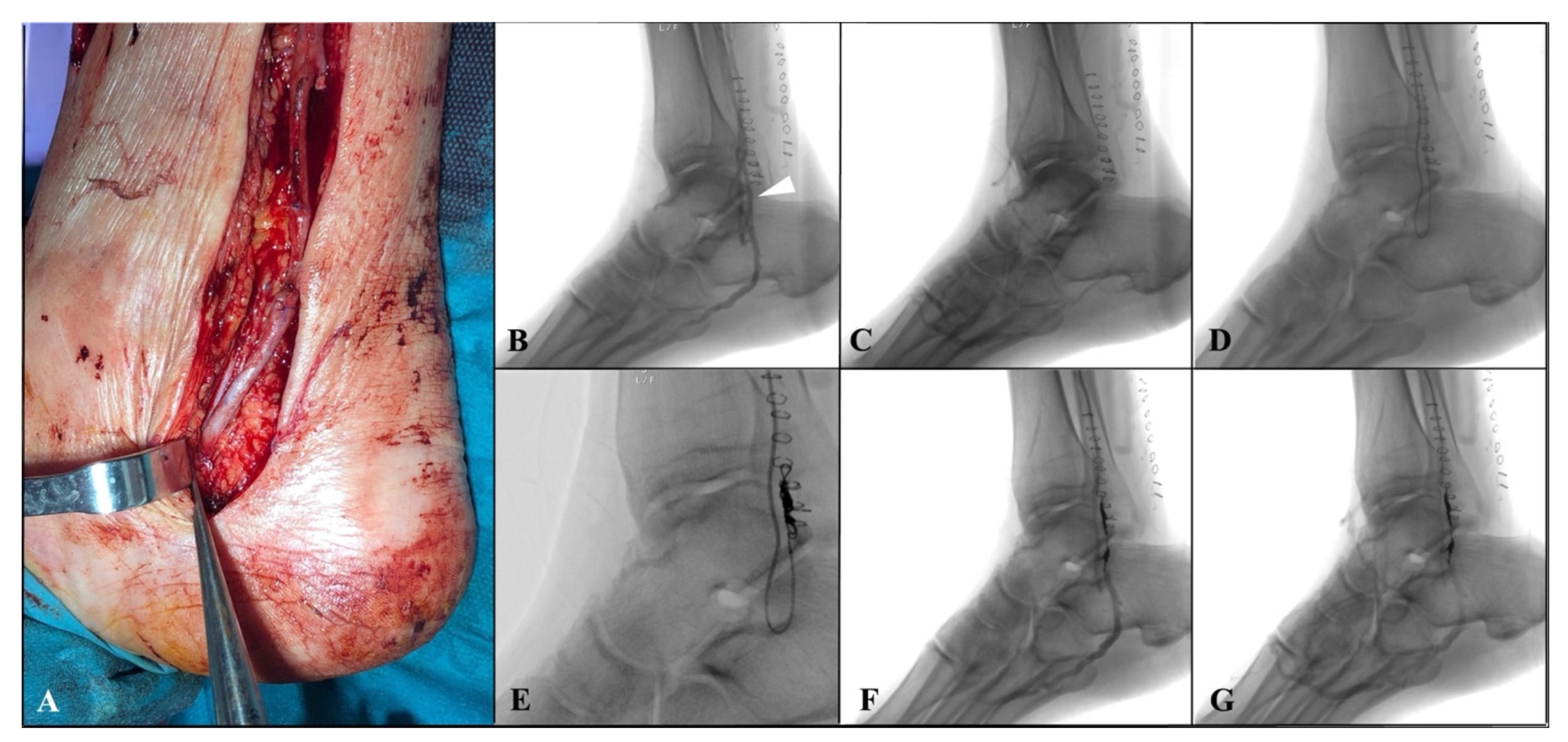 Hybrid superficial venous arterialization and endovascular deep venous  arterialization - Journal of Vascular Surgery Cases, Innovations and  Techniques