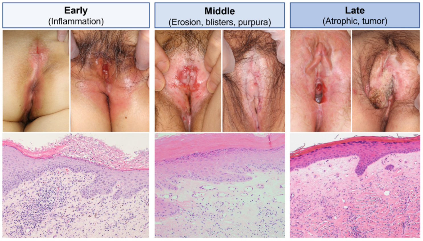 Diagnostics Free Full Text Lichen Sclerosus A Current