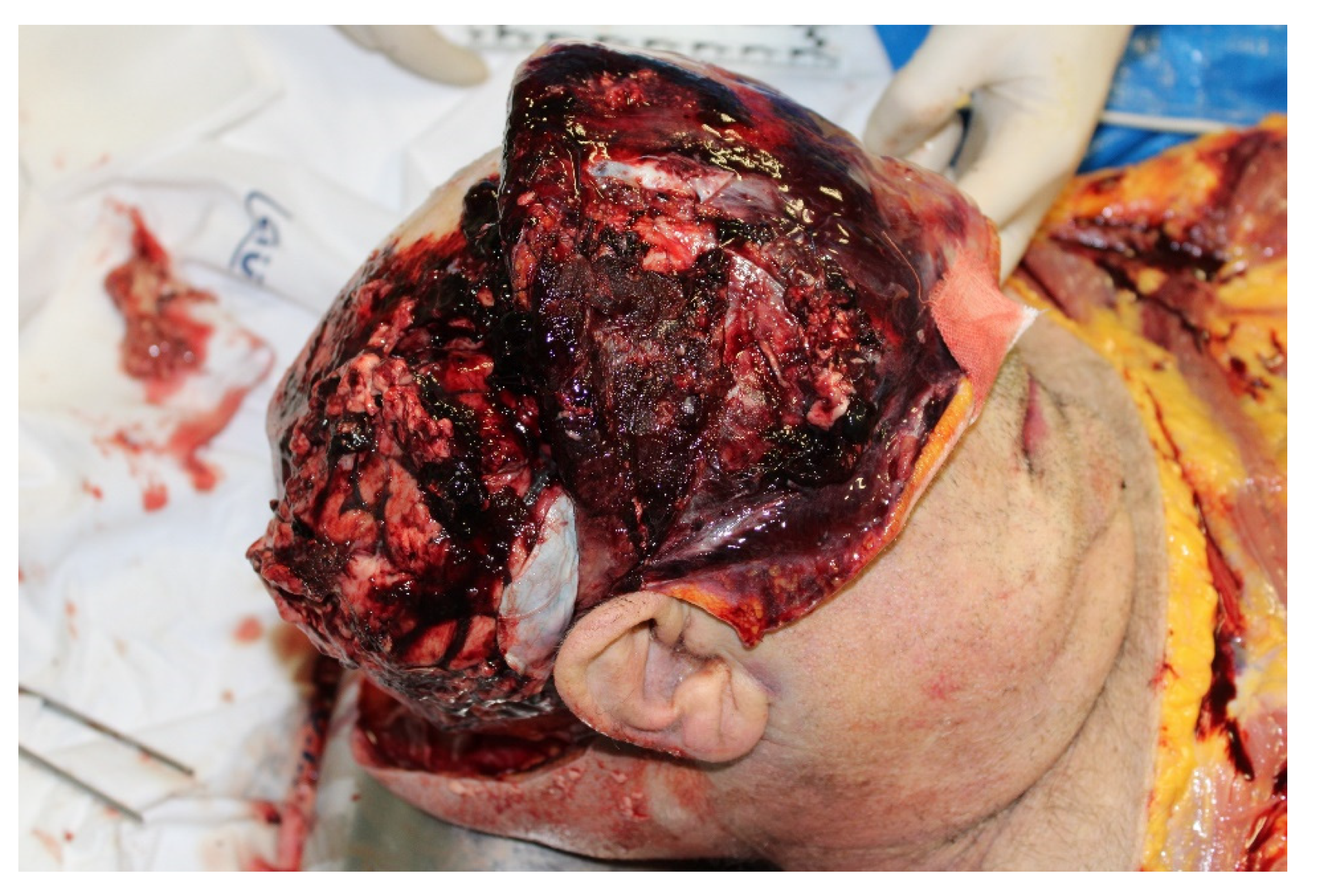 autupsy The Role of Autopsy and Post-Mortem Investigations in Falling Traumas in  the Hospital Environment