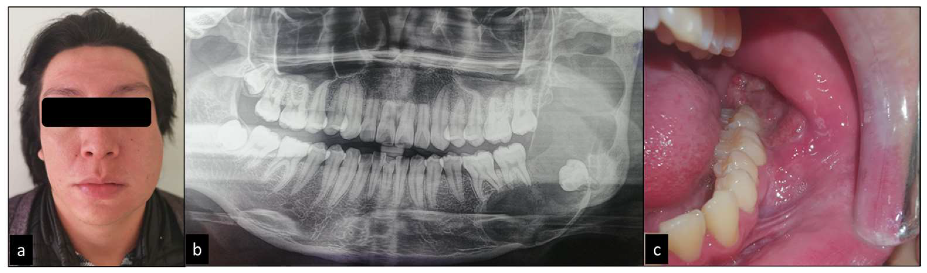 Ameloblastoma X Ray