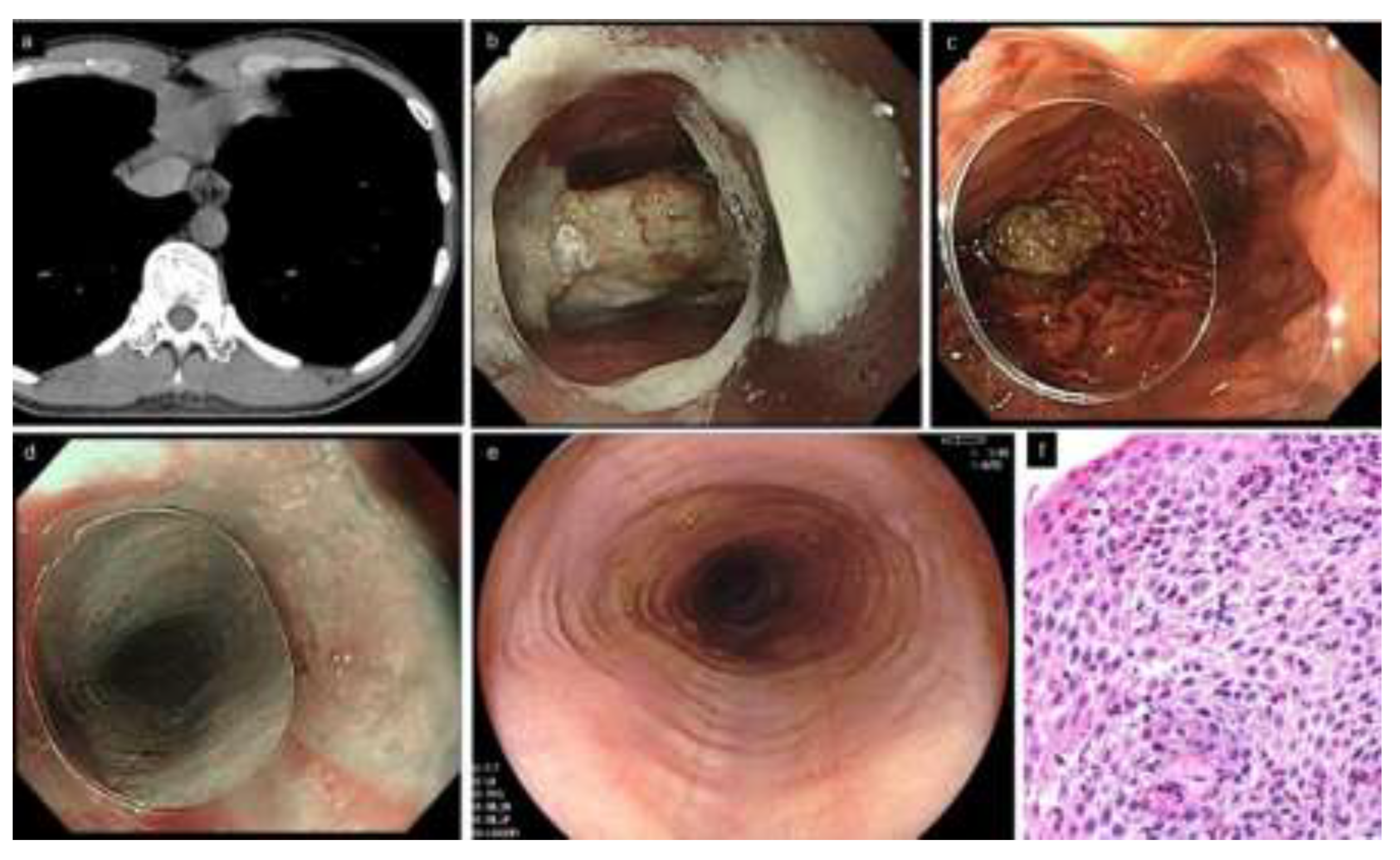 Systematic Review: esophageal motility patterns in patients with eosinophilic  esophagitis
