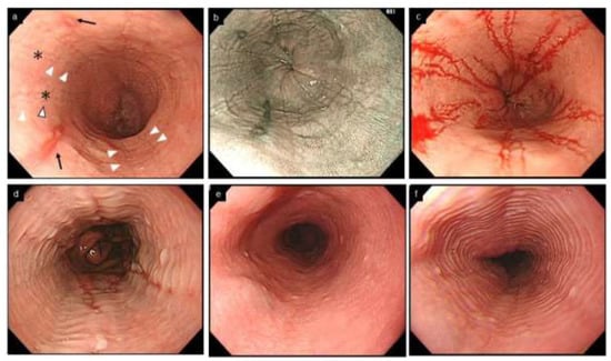 Clinical presentation and endoscopic findings in adult patients with eosinophilic  esophagitis