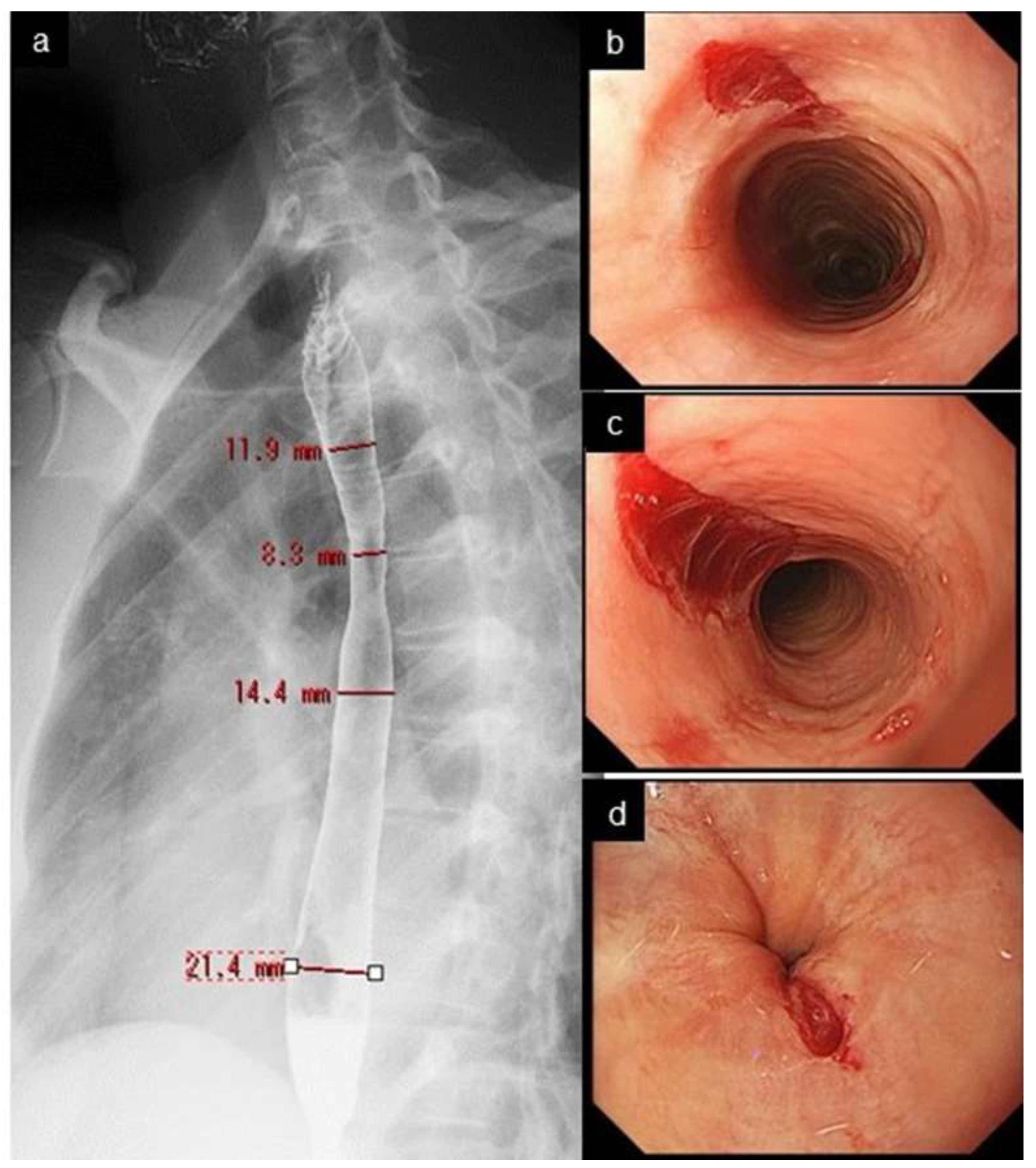 Eosinophilic esophagitis