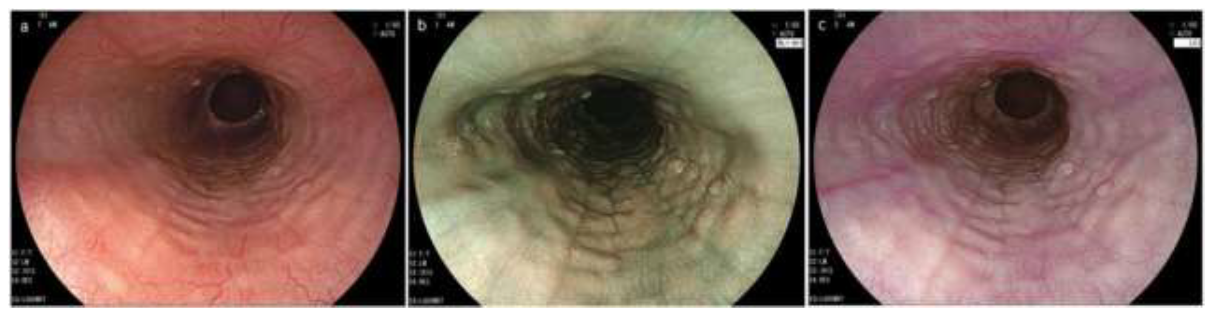 Idiopathic Eosinophilic Esophagitis in Adults: The Ringed Esophagus |  Radiology
