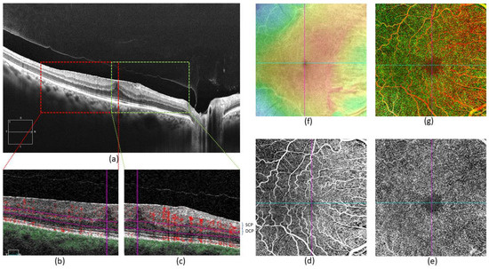 Superficial and Deep Capillary Plexuses: Potential Biomarkers of Focal ...
