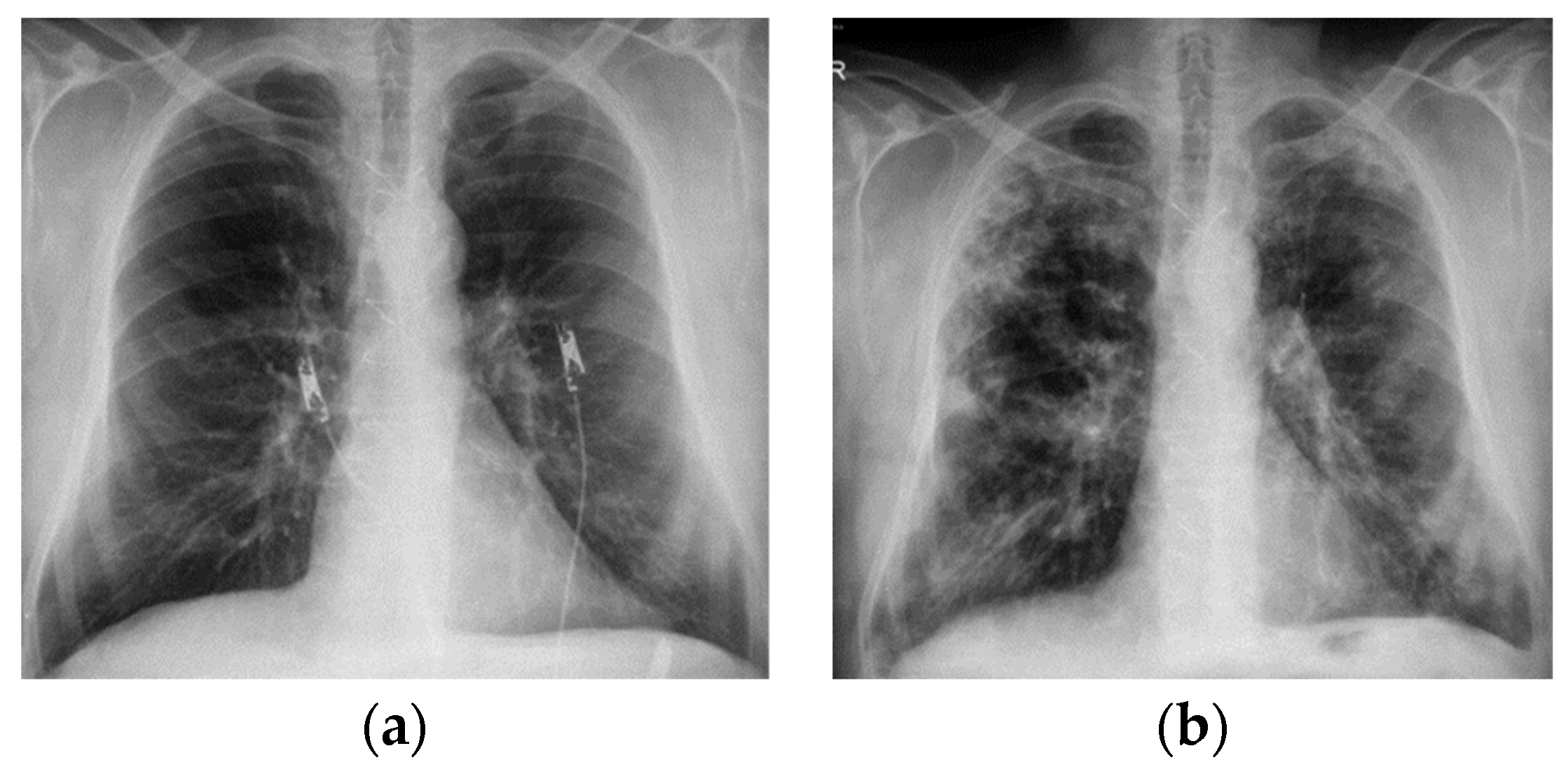 diagnostics-free-full-text-pulmonary-fibrosis-related-to-amiodarone