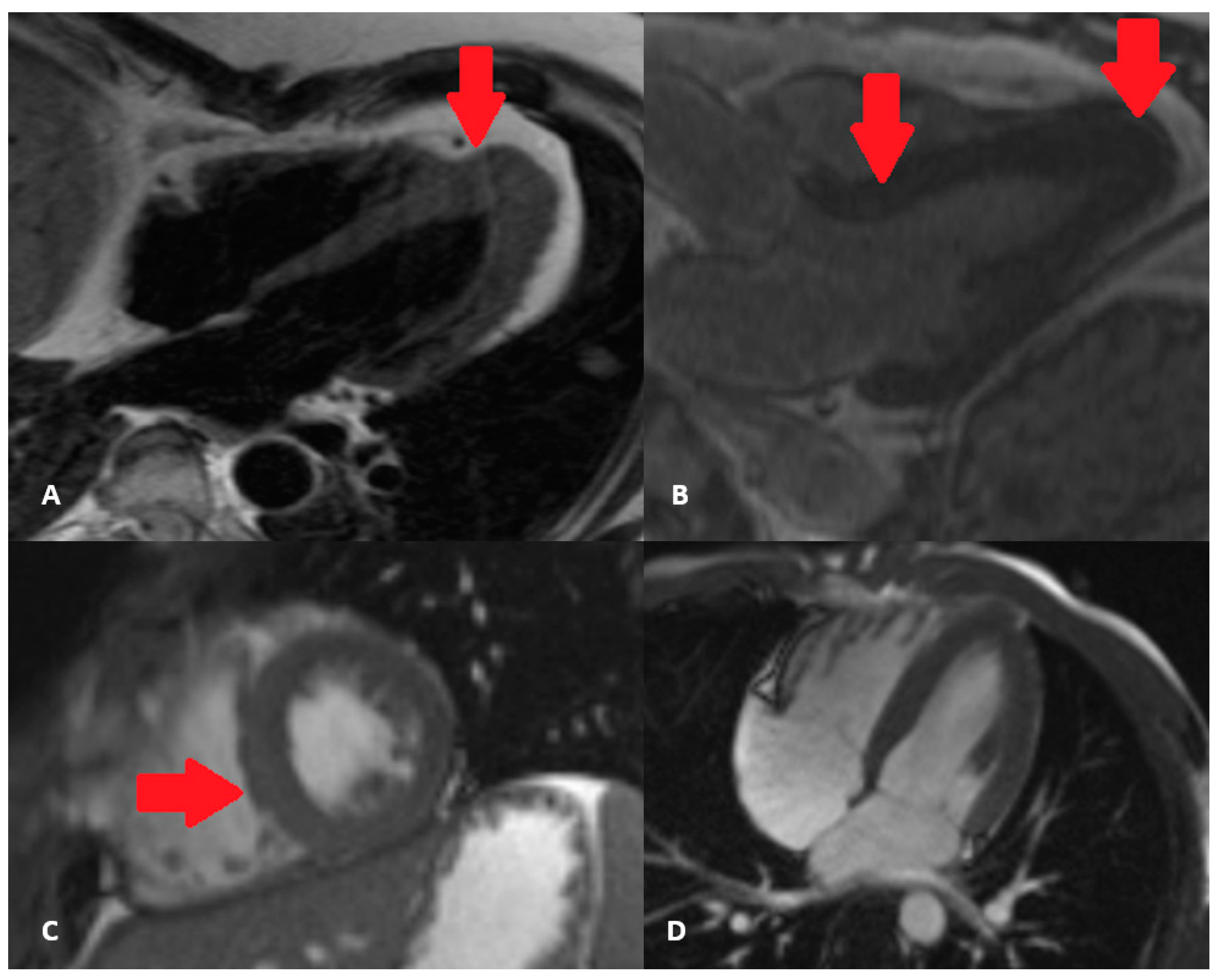 Cardiac Magnetic Resonance in Hypertensive Heart Disease
