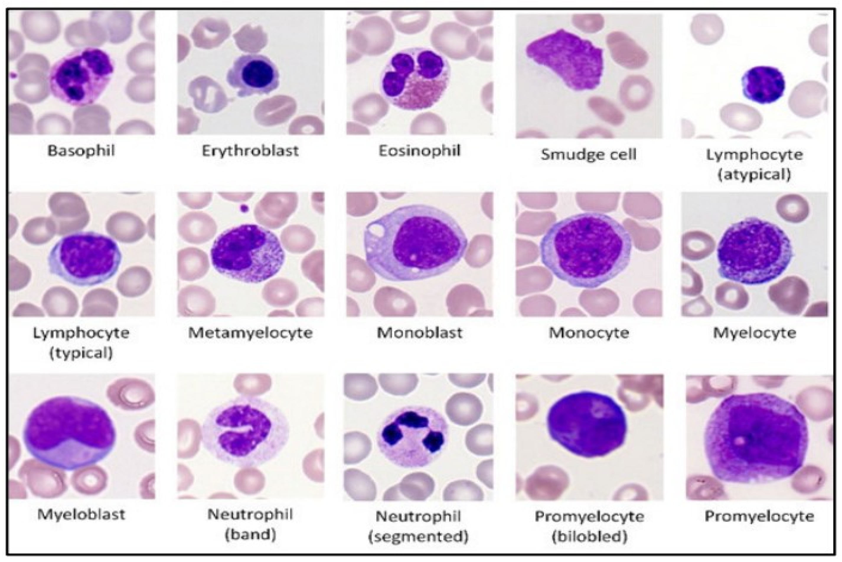 myelocyte and metamyelocyte