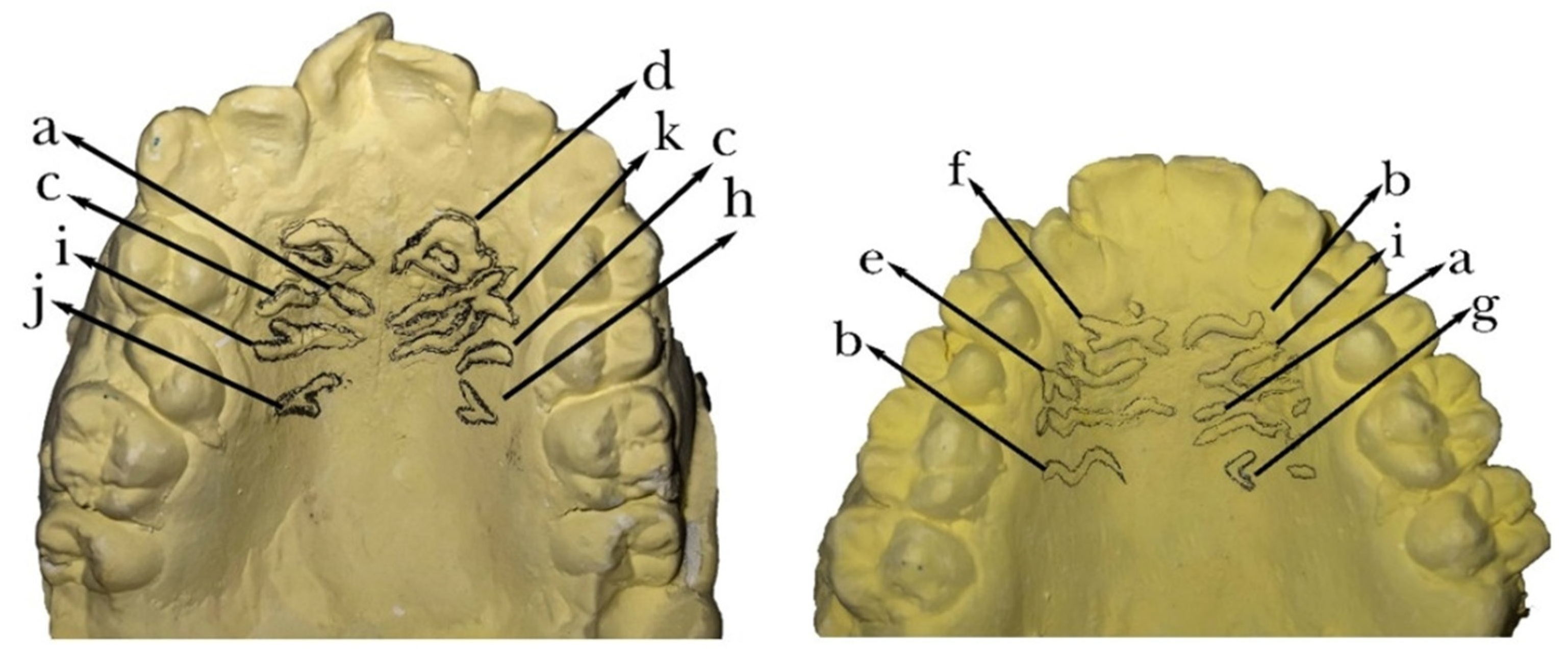Diagnostics Free FullText Palatal Rugae Patterns in Fars, Turkmen