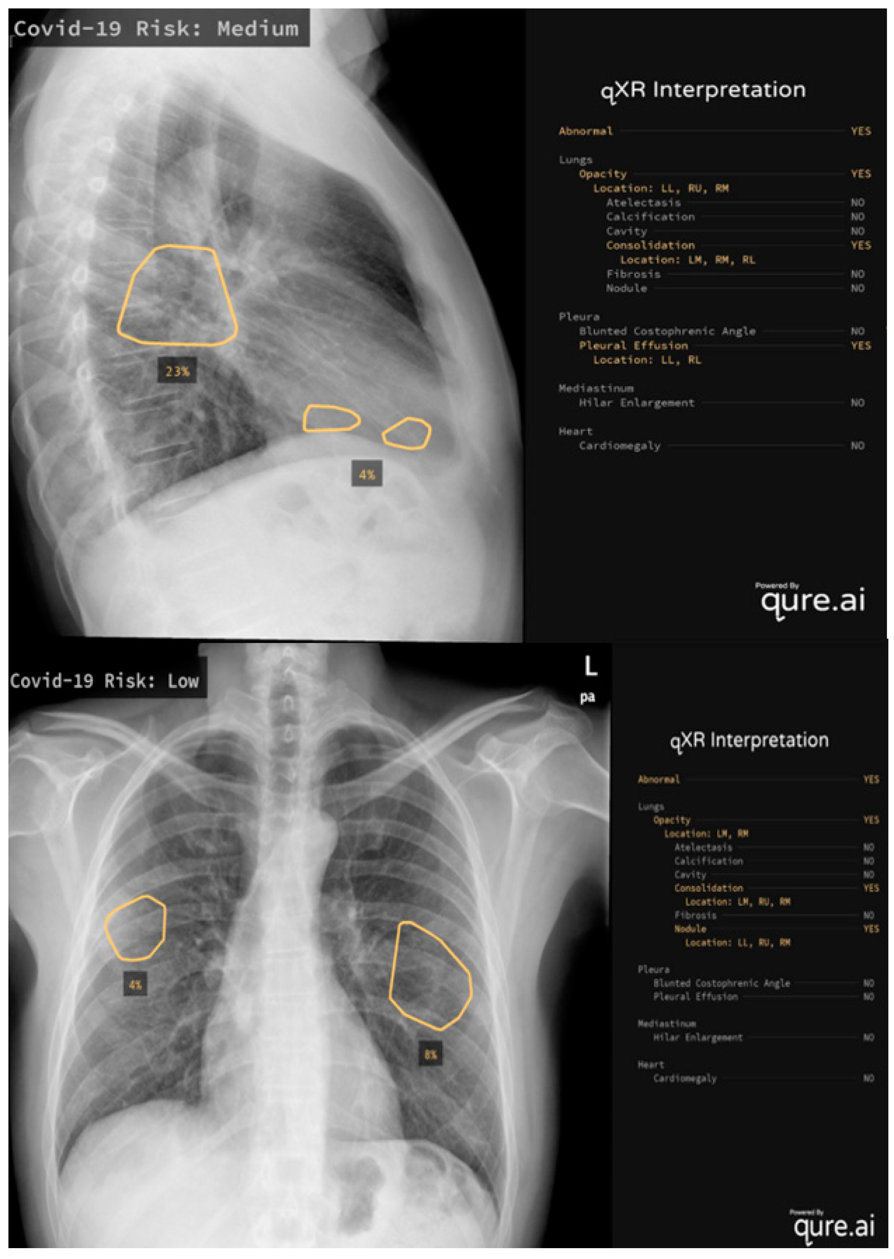 AI Analysis Can Improve Lung Cancer Detection on Chest Radiographs