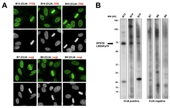 The Nuclear Dense Fine Speckled (DFS) Immunofluorescence Pattern: Not ...
