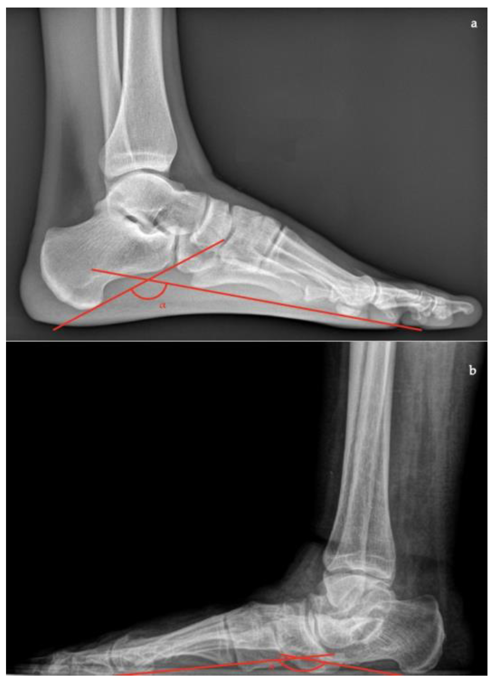 Diagnostics Free FullText Adult Acquired Flatfoot Deformity A