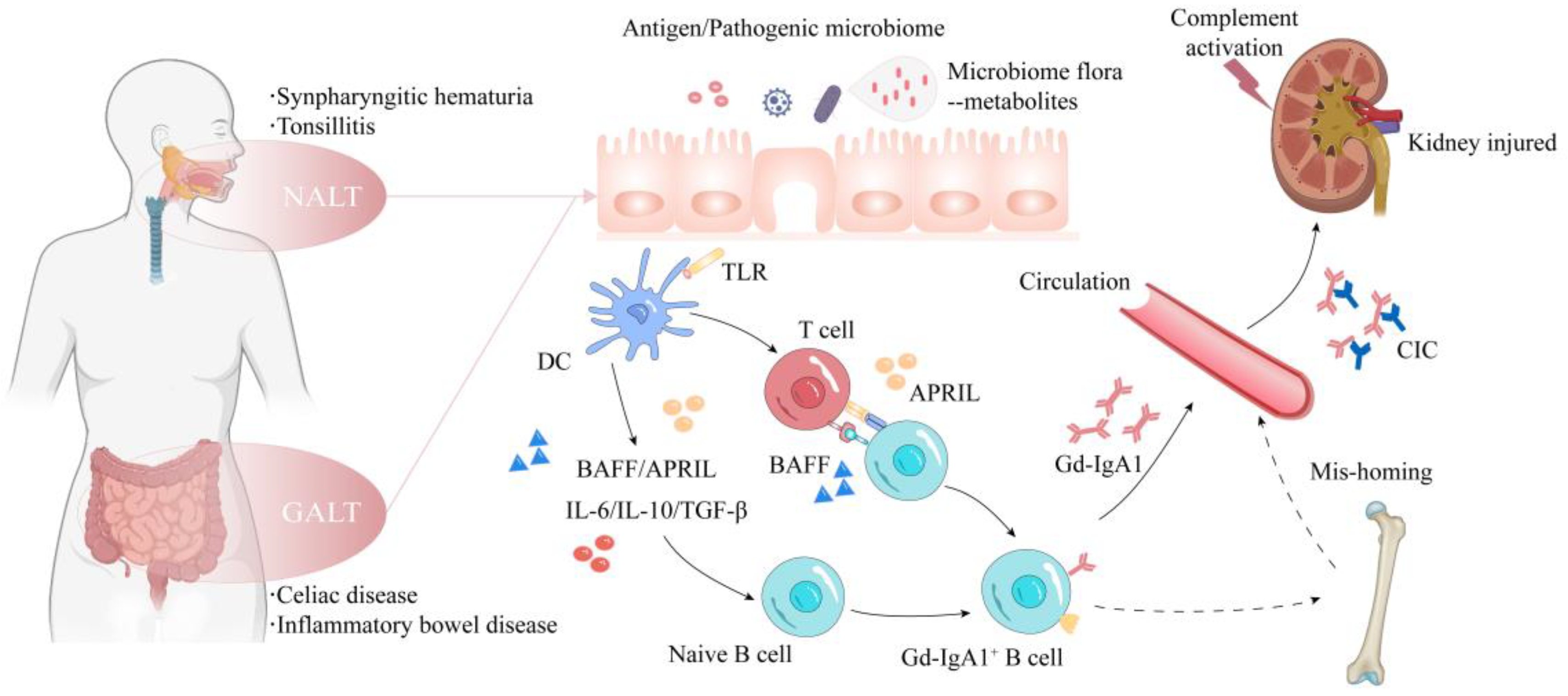 Secondary IgA Nephropathy ScienceDirect 53 OFF