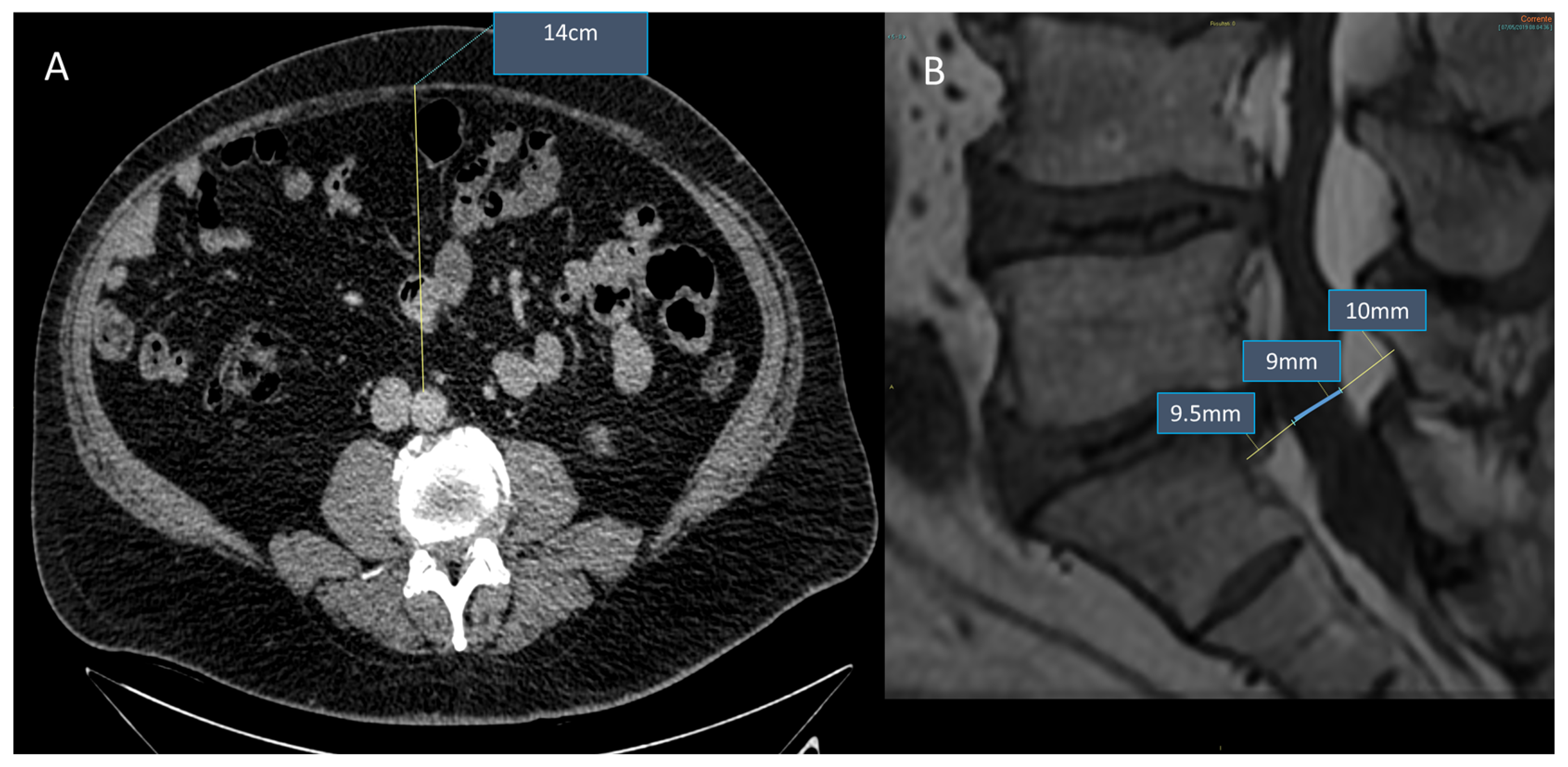 what-does-prominent-dorsal-epidural-fat-mean-infoupdate