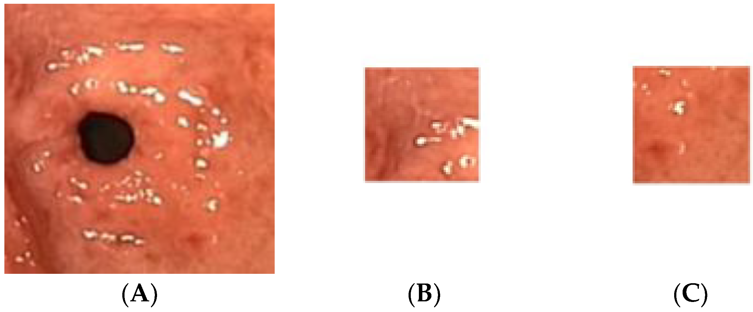 Diagnostics Free FullText H. pylori Related Atrophic Gastritis