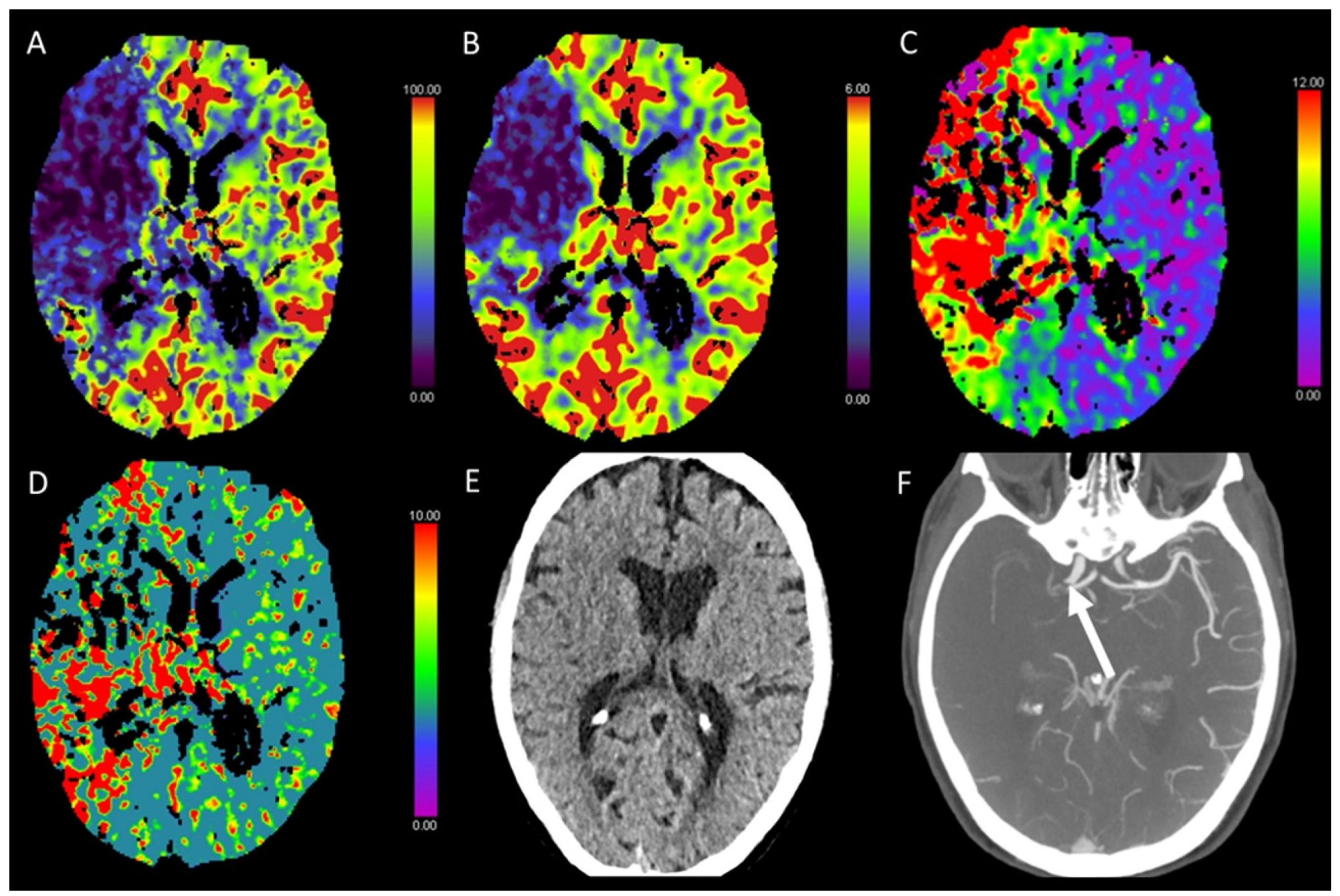 Pictorial Review on Imaging Findings in Cerebral CTP in Patients 