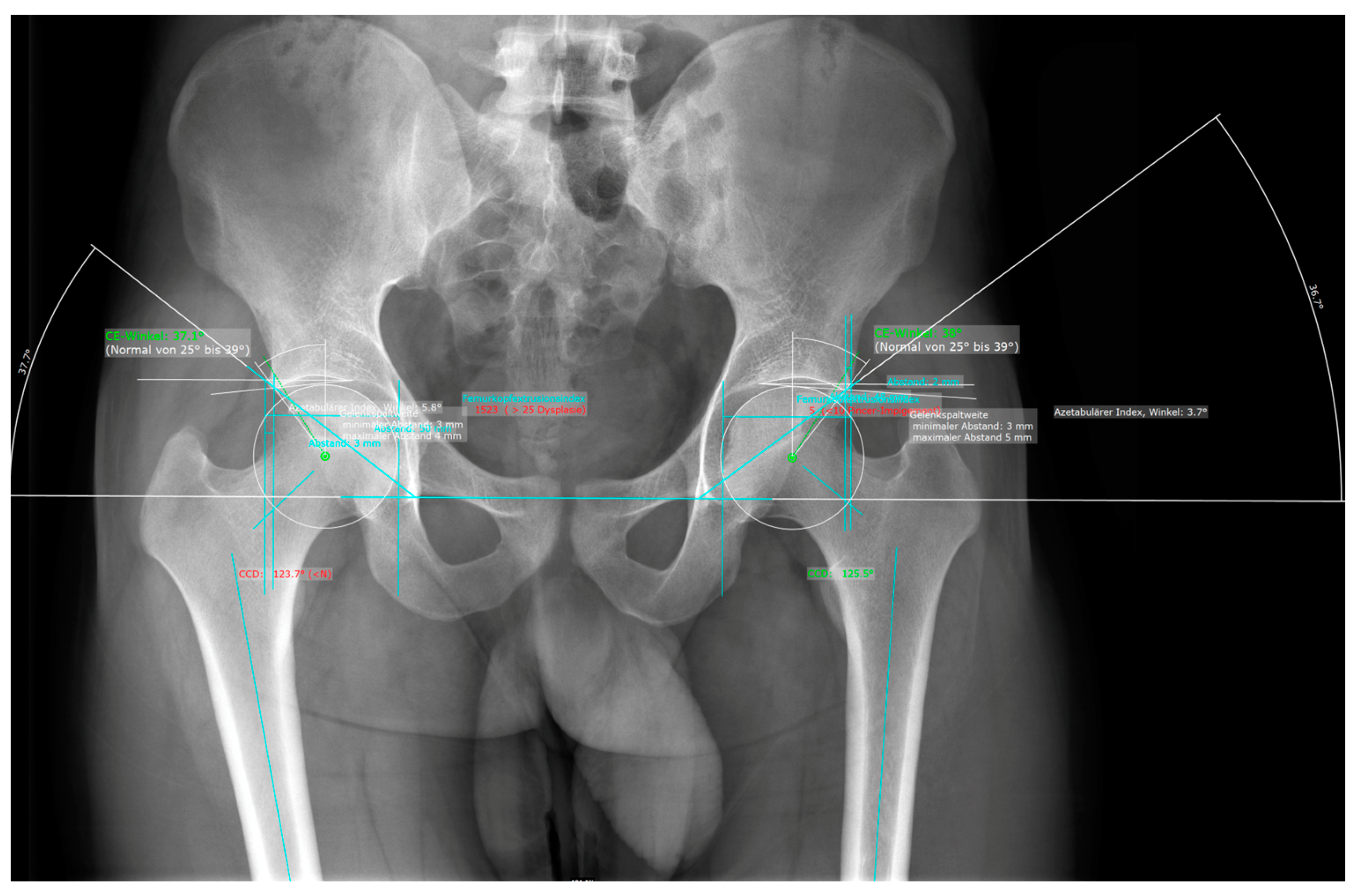 Deep Learning for Fully Automated Radiographic Measurements of the Deep Learning for Fully Automated Radiographic Measurements of the