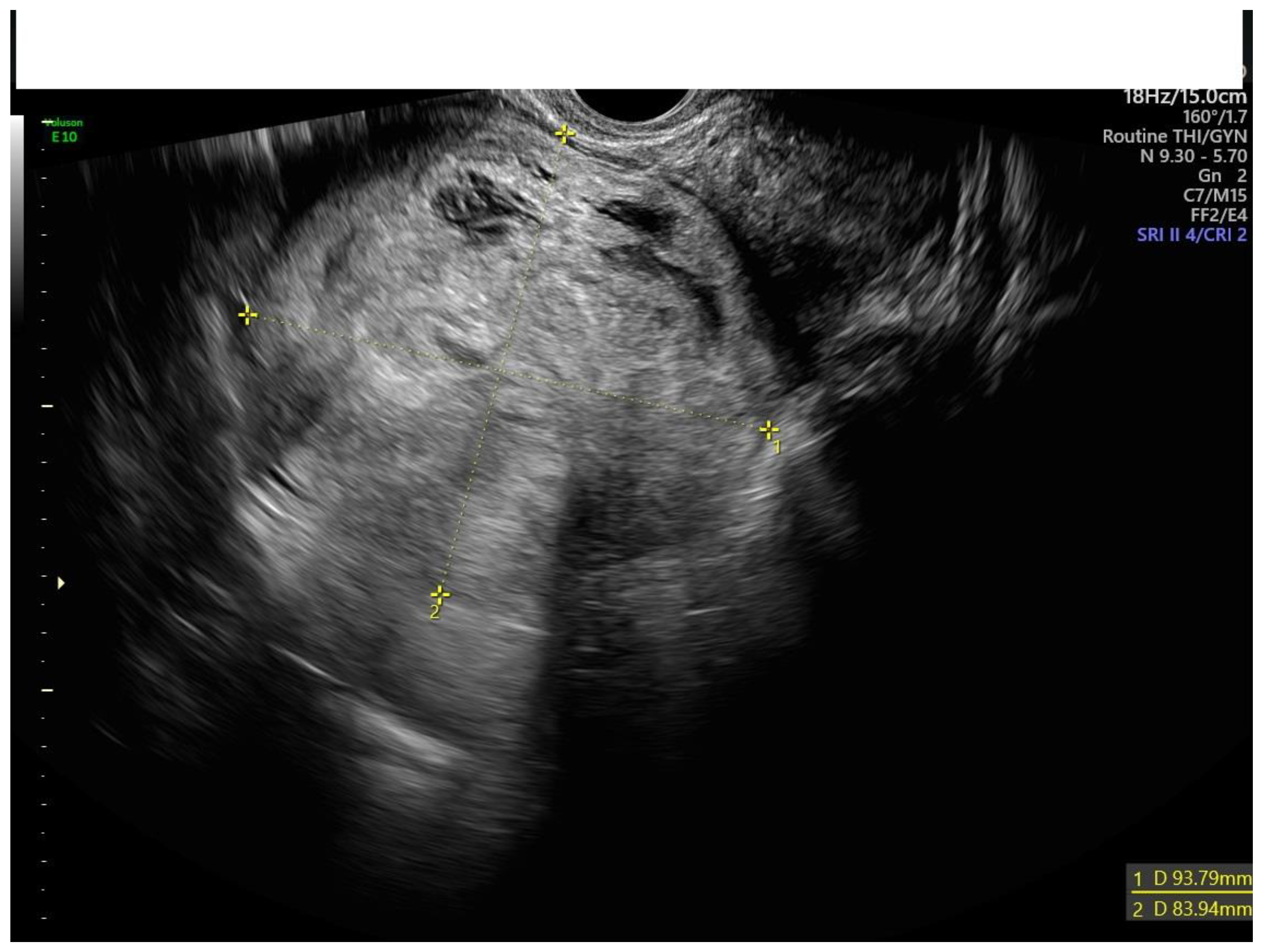 transvaginal-ultrasound-fibroids
