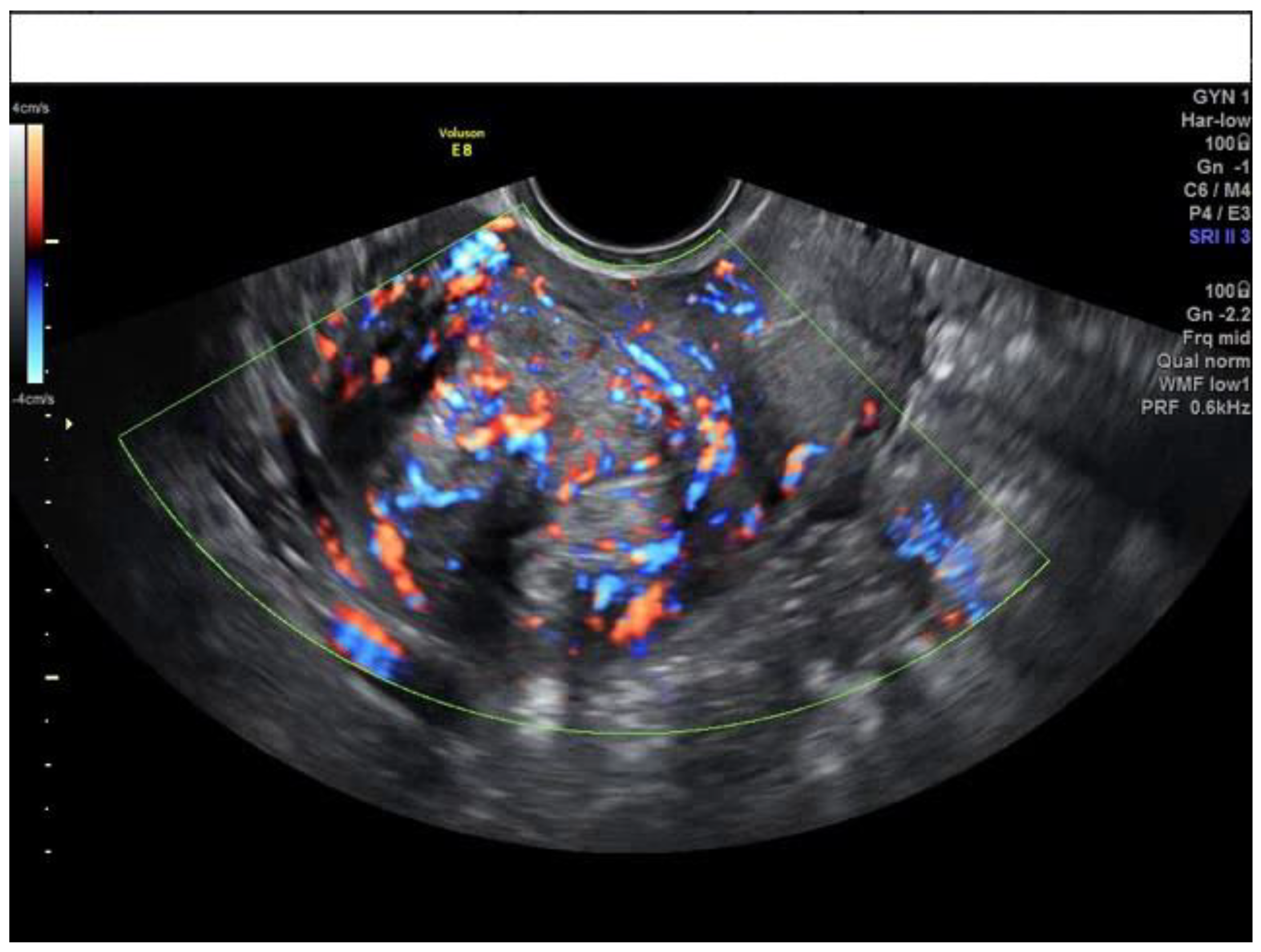Transvaginal ultrasound from a 28-year-old woman with a left ectopic... |  Download Scientific Diagram