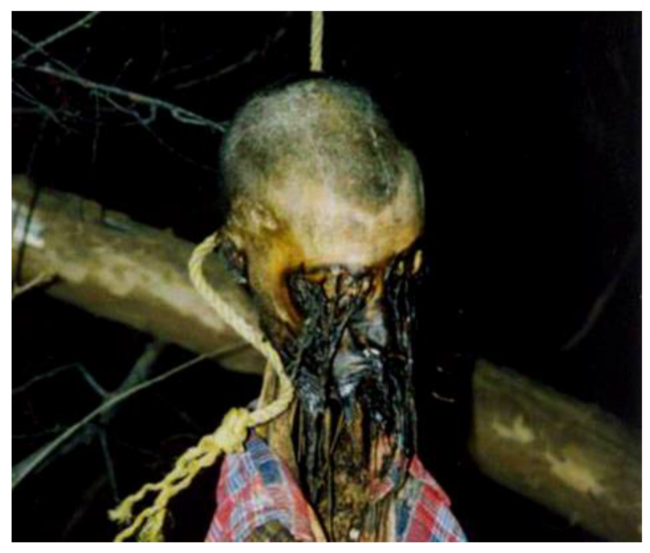 hanging Diagnostic Methods in Forensic Pathology: A New Sign in Death from Hanging