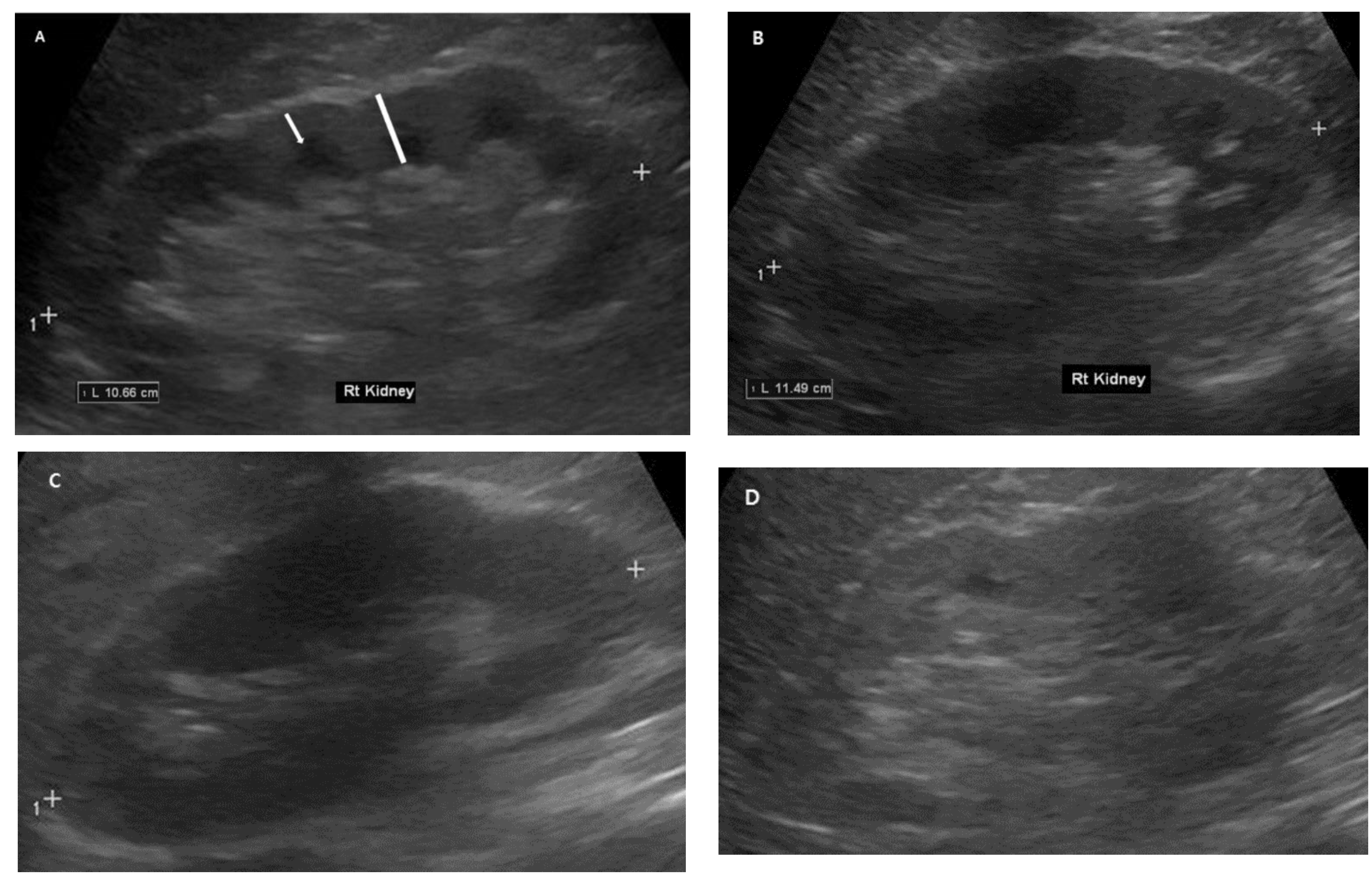 Kidney Ultrasound Images Normal