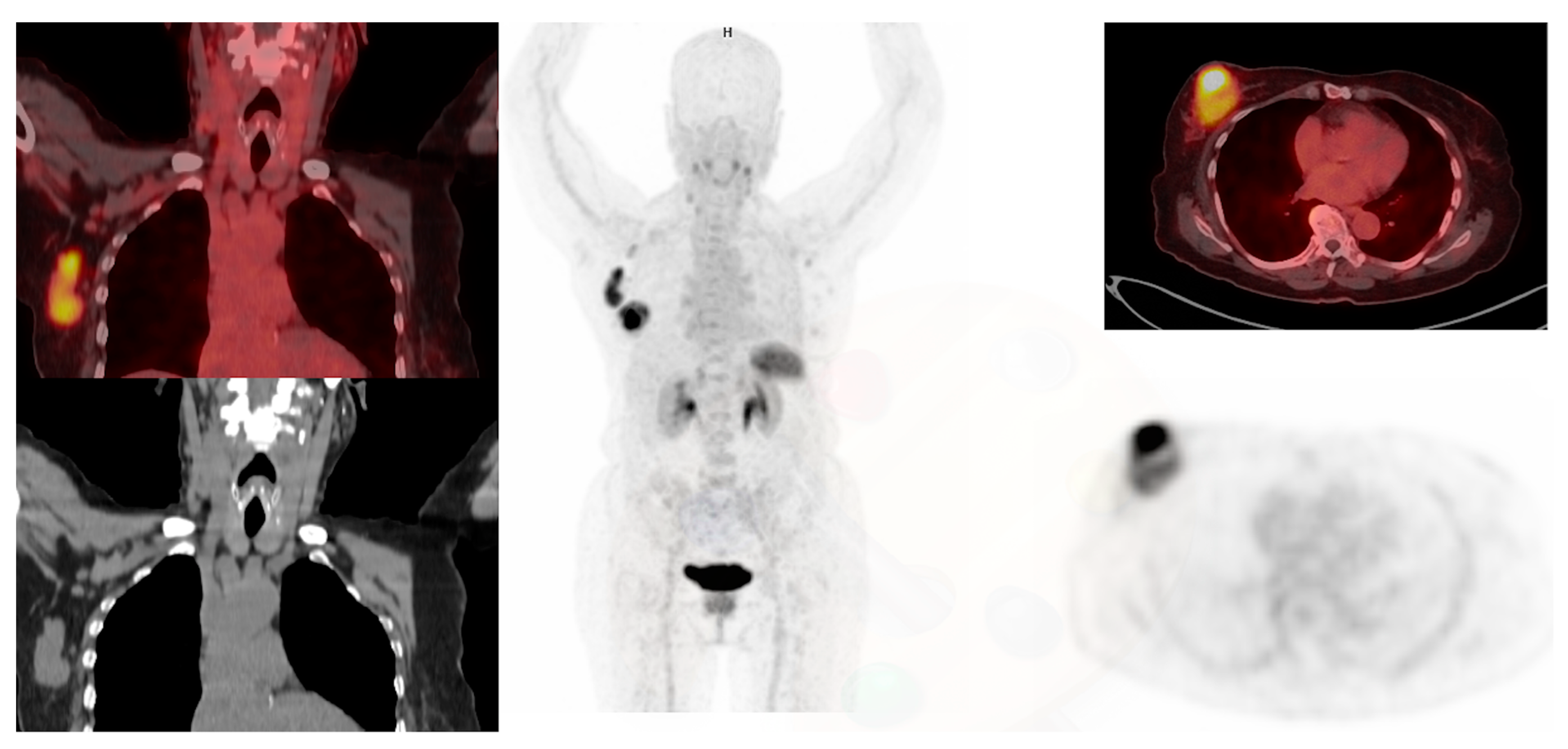 Diagnostics Free Full Text The Role of PET/CT in Breast Cancer Diagnostics Free Full Text The Role of PET/CT in Breast Cancer