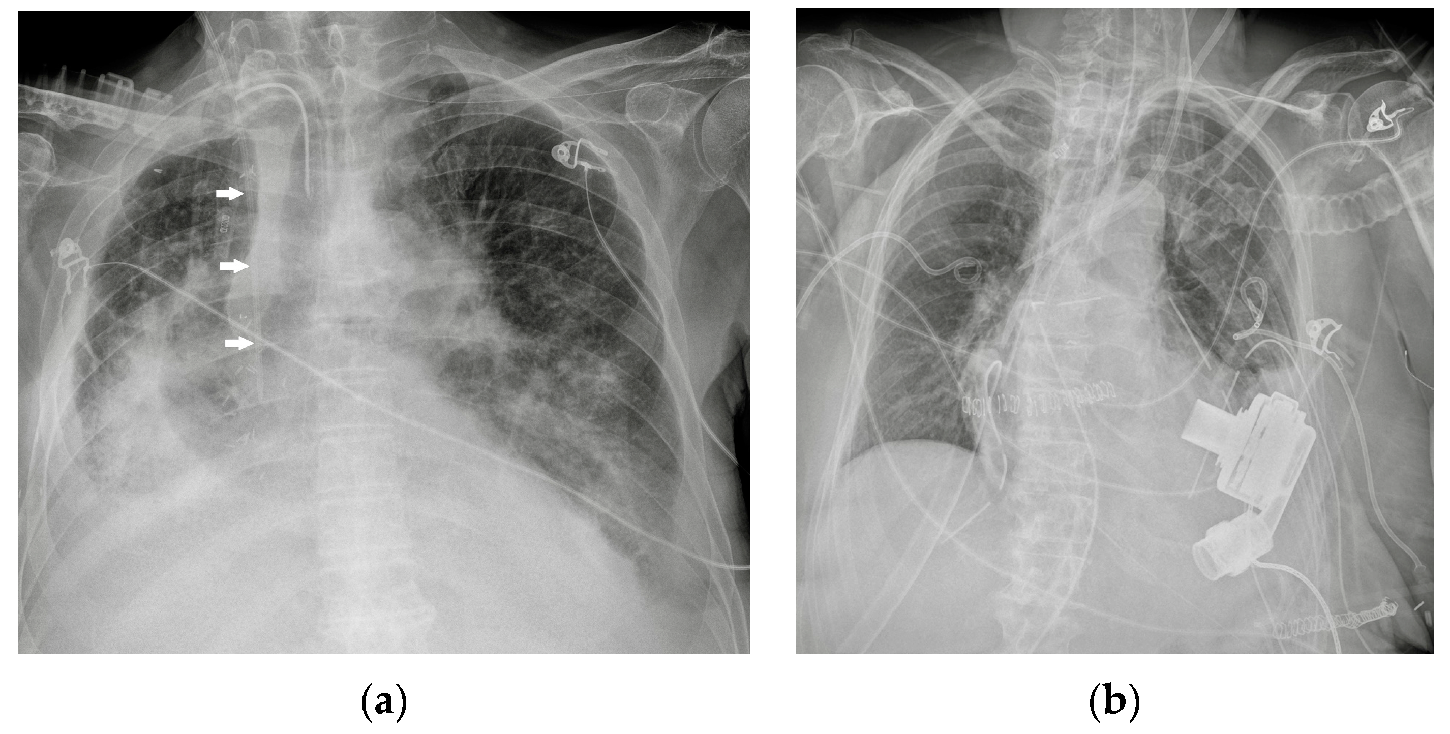 chest tube x ray