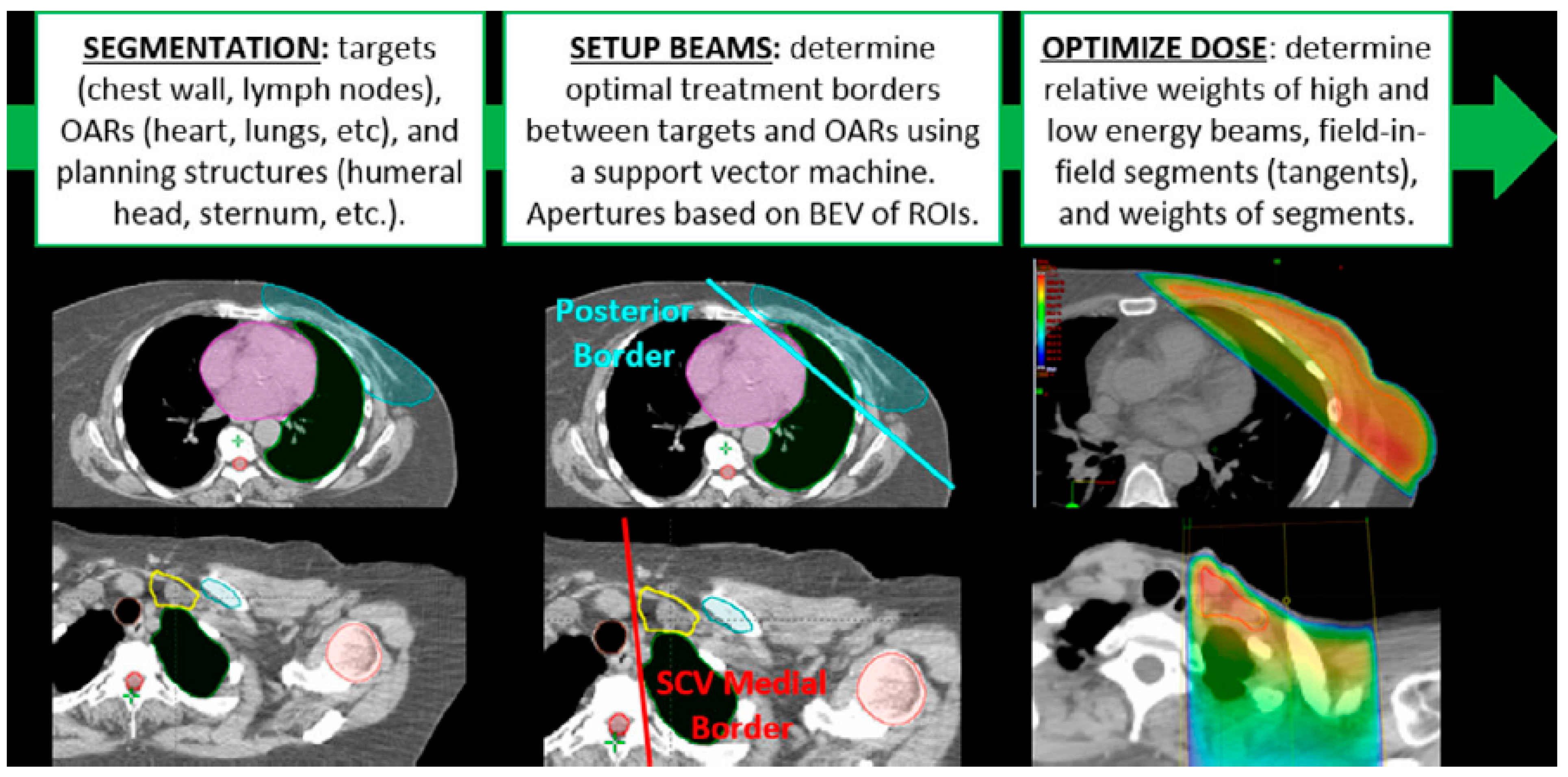 Research shows side effects of radiation therapy are reduced when computer  optimizes treatment