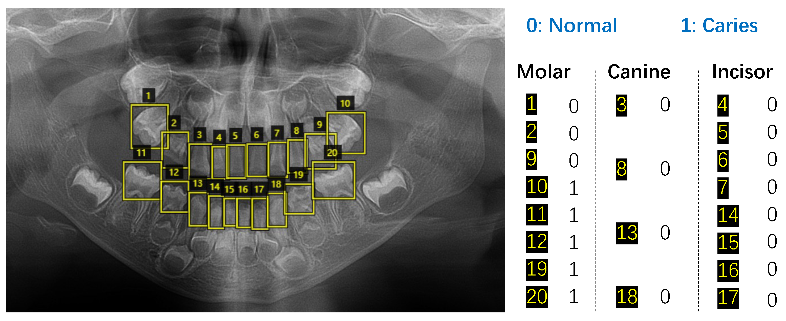 Diagnostics Free FullText Tooth Type Enhanced Transformer for Children Caries Diagnosis on