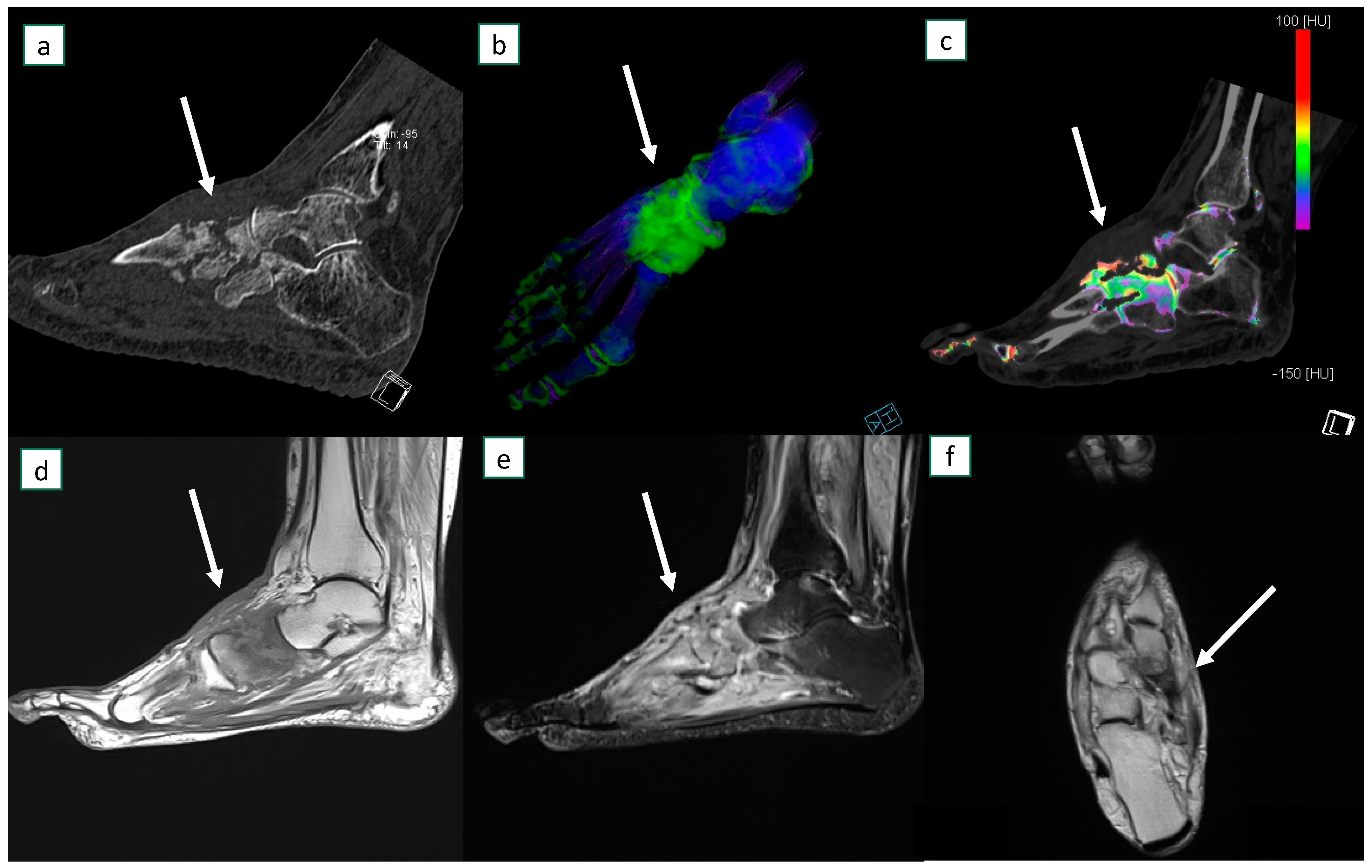 Diagnostics Free FullText Osteomyelitis of the Lower Limb Diagnostic Accuracy of Dual