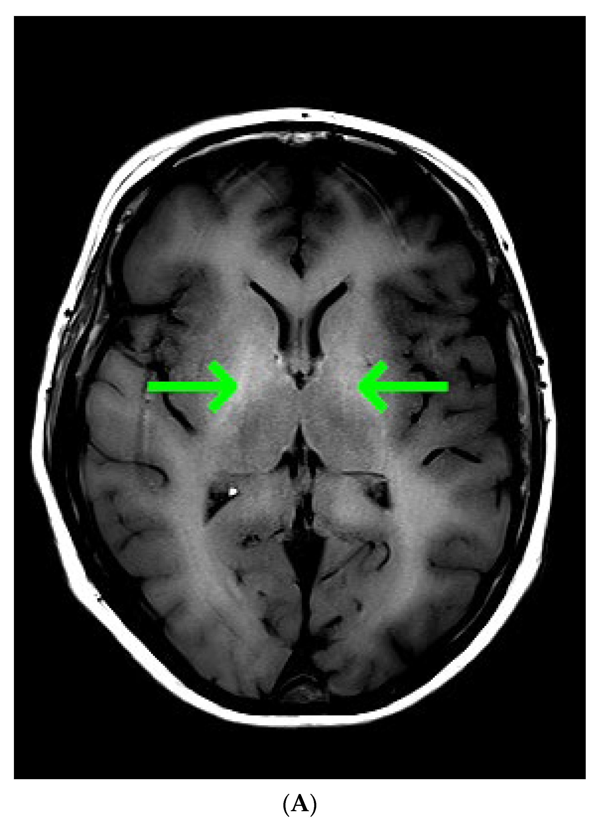 gabapentin hepatic encephalopathy