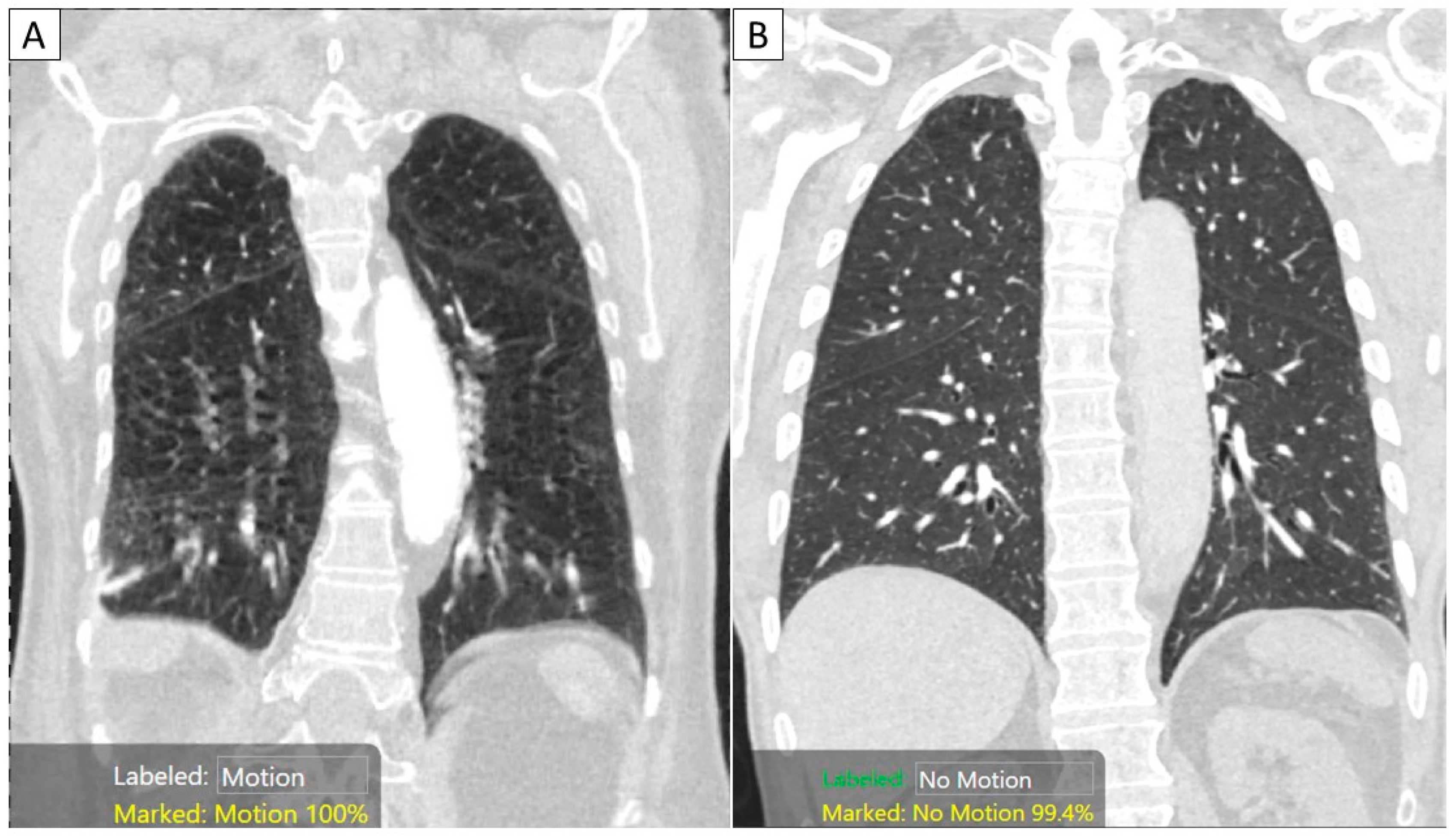 Diagnostics Free FullText AutoDetection of Motion Artifacts on CT