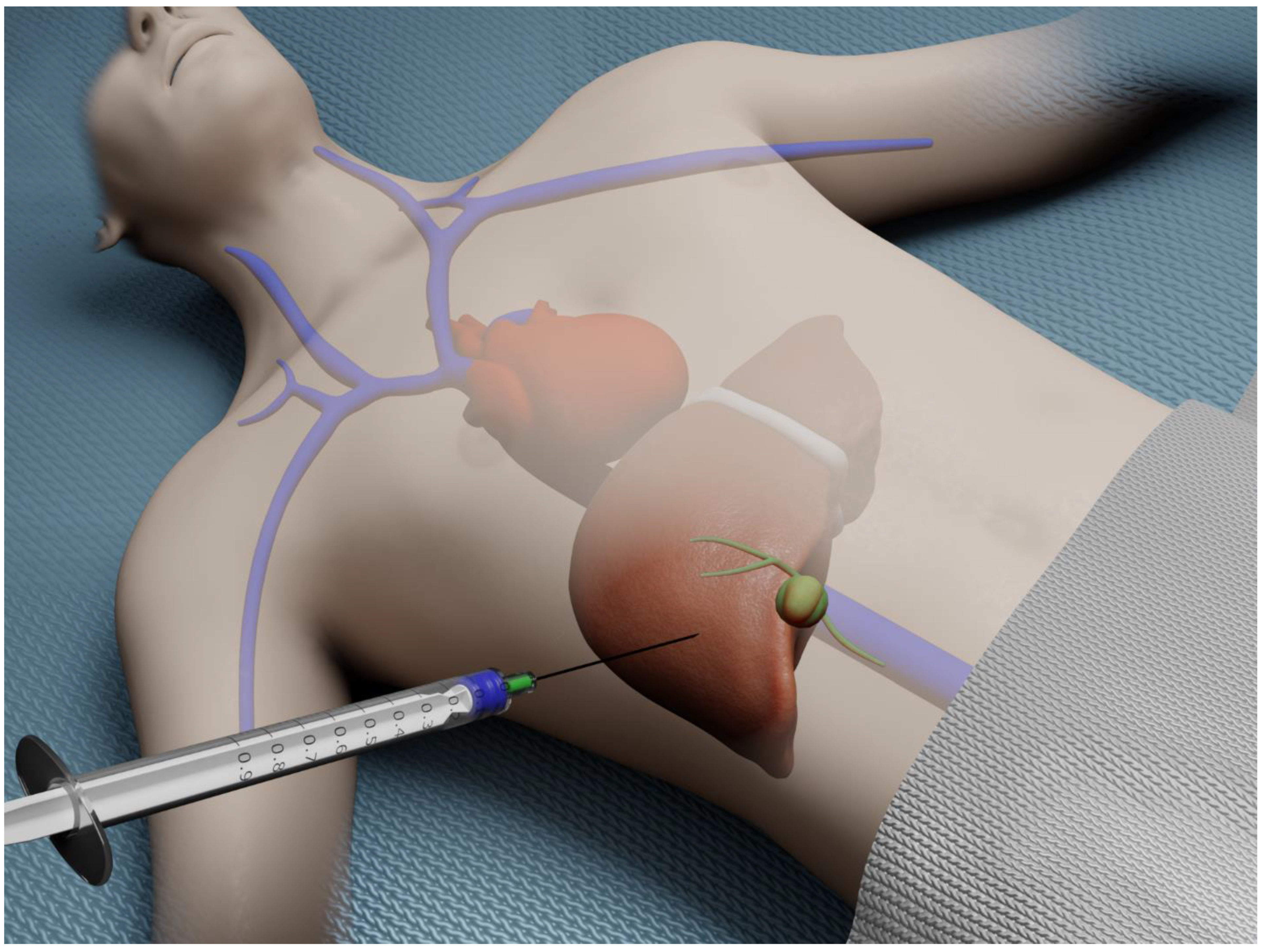 Diagnostics | Free Full-Text | Advances in Endoscopic Ultrasound  (EUS)-Guided Liver Biopsy