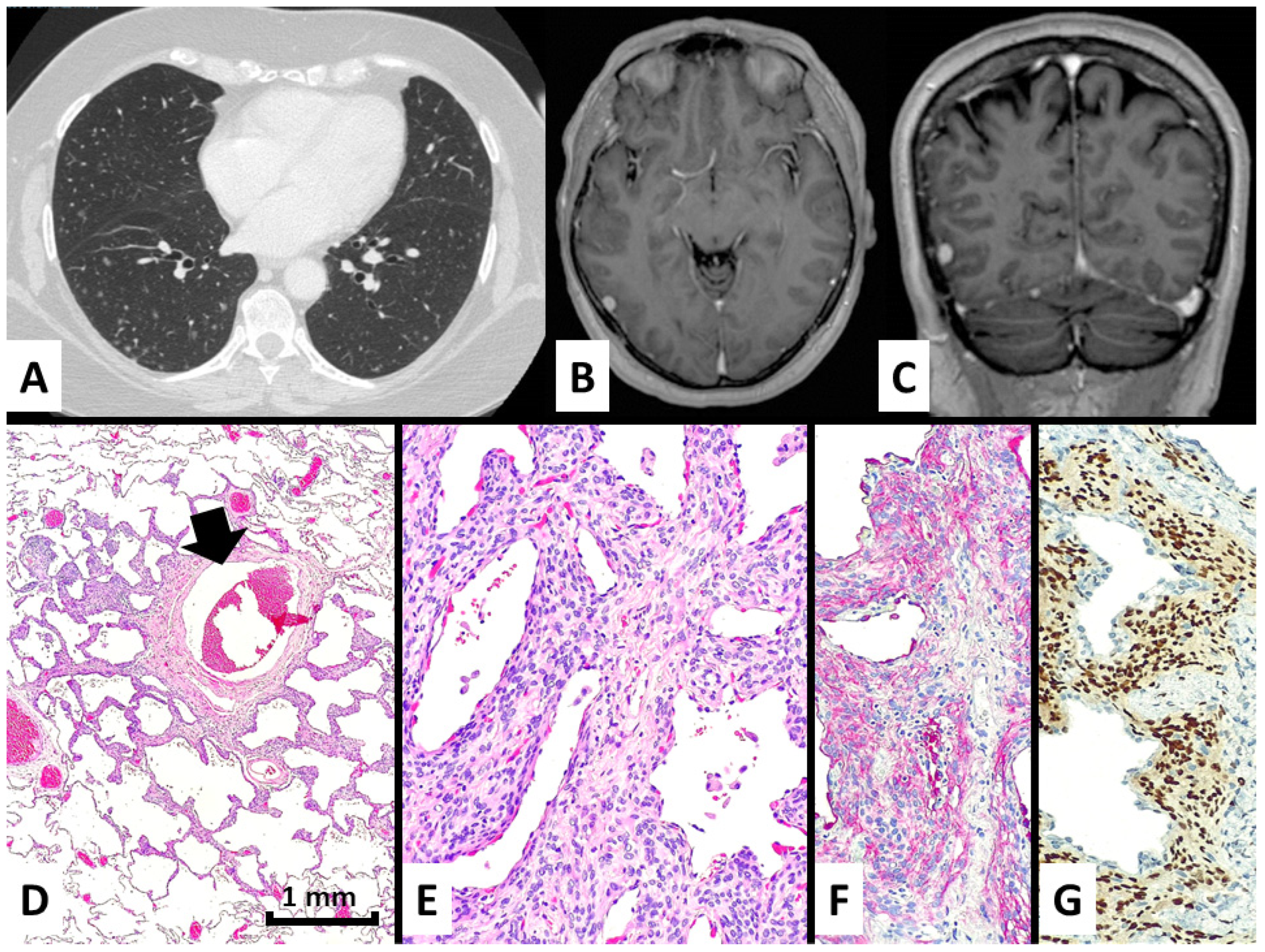 Diffuse Lung Diseases: Clinical Features， Pathology， HRCT