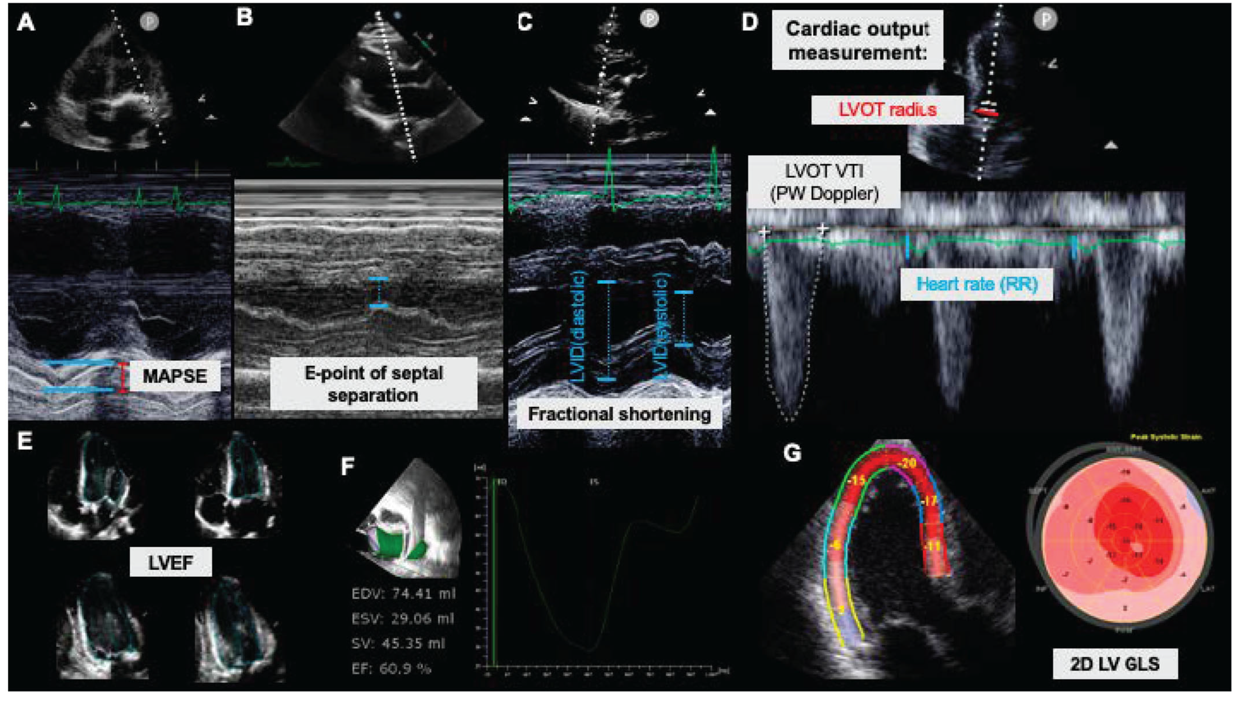 Cardiac function refers to the heart's ability to pump blood efficiently throughout the body. It is evaluated using various indices that assess both systolic and diastolic functions.