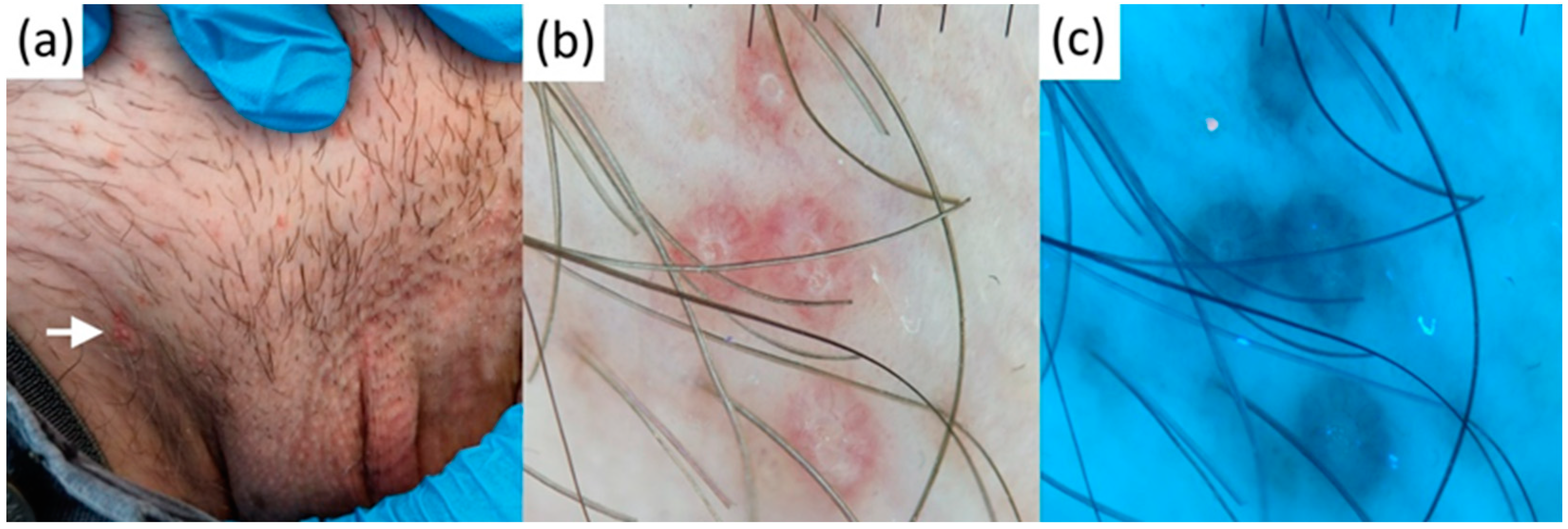 Differentiating Fordyce Spots from Their Common Simulators Using
