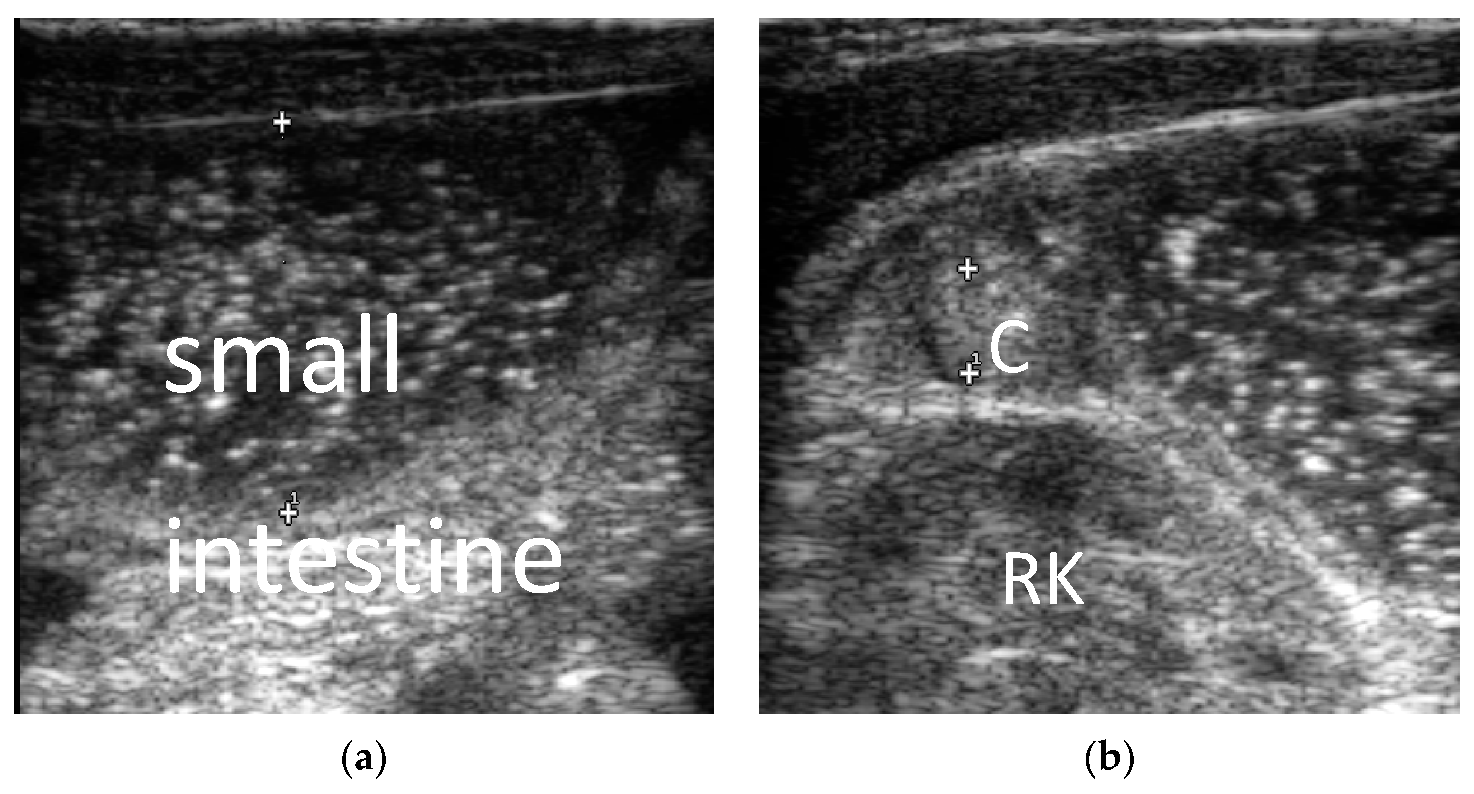Diagnostics Free FullText Ultrasonic Diagnosis of Intestinal