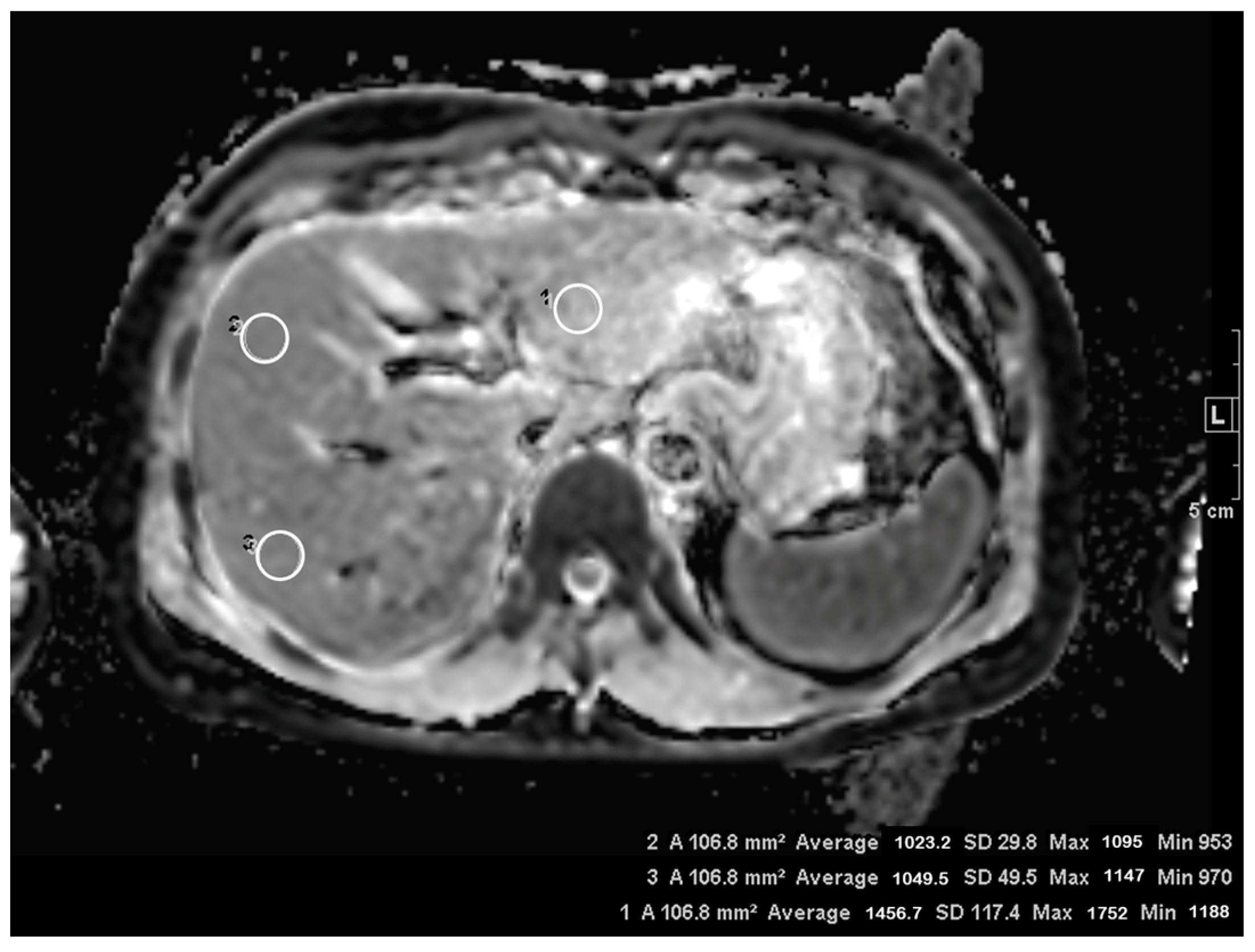 ADC values (mm2/s) of tumor and liver at different time points.