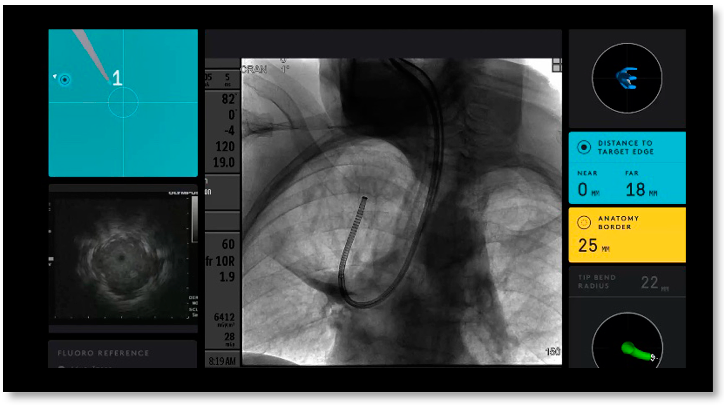 Jornal Brasileiro de Pneumologia - Predictive factors for improved  diagnostic accuracy with the use of radial-probe EBUS