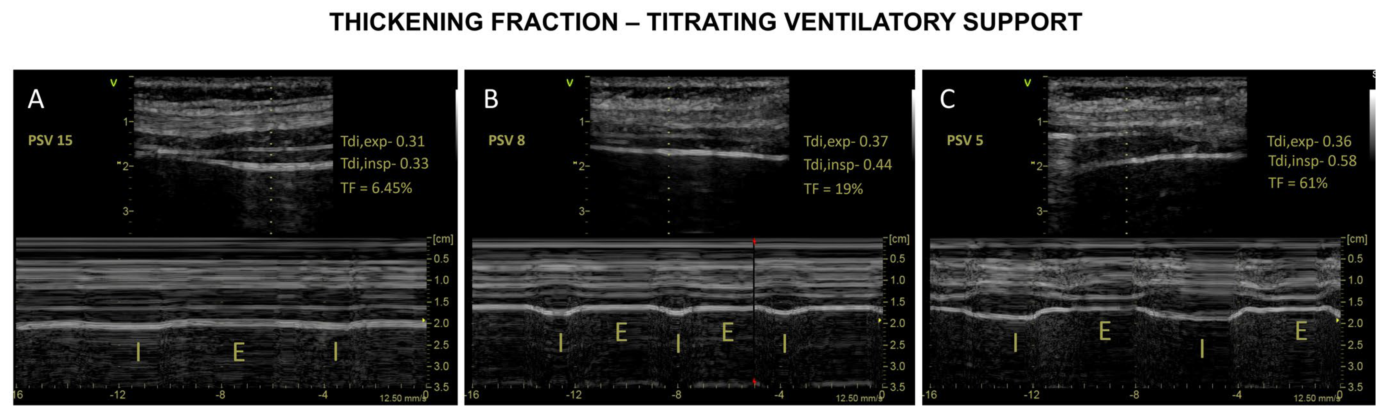 Diagnostics Free FullText Diaphragm Ultrasound in Critically Ill