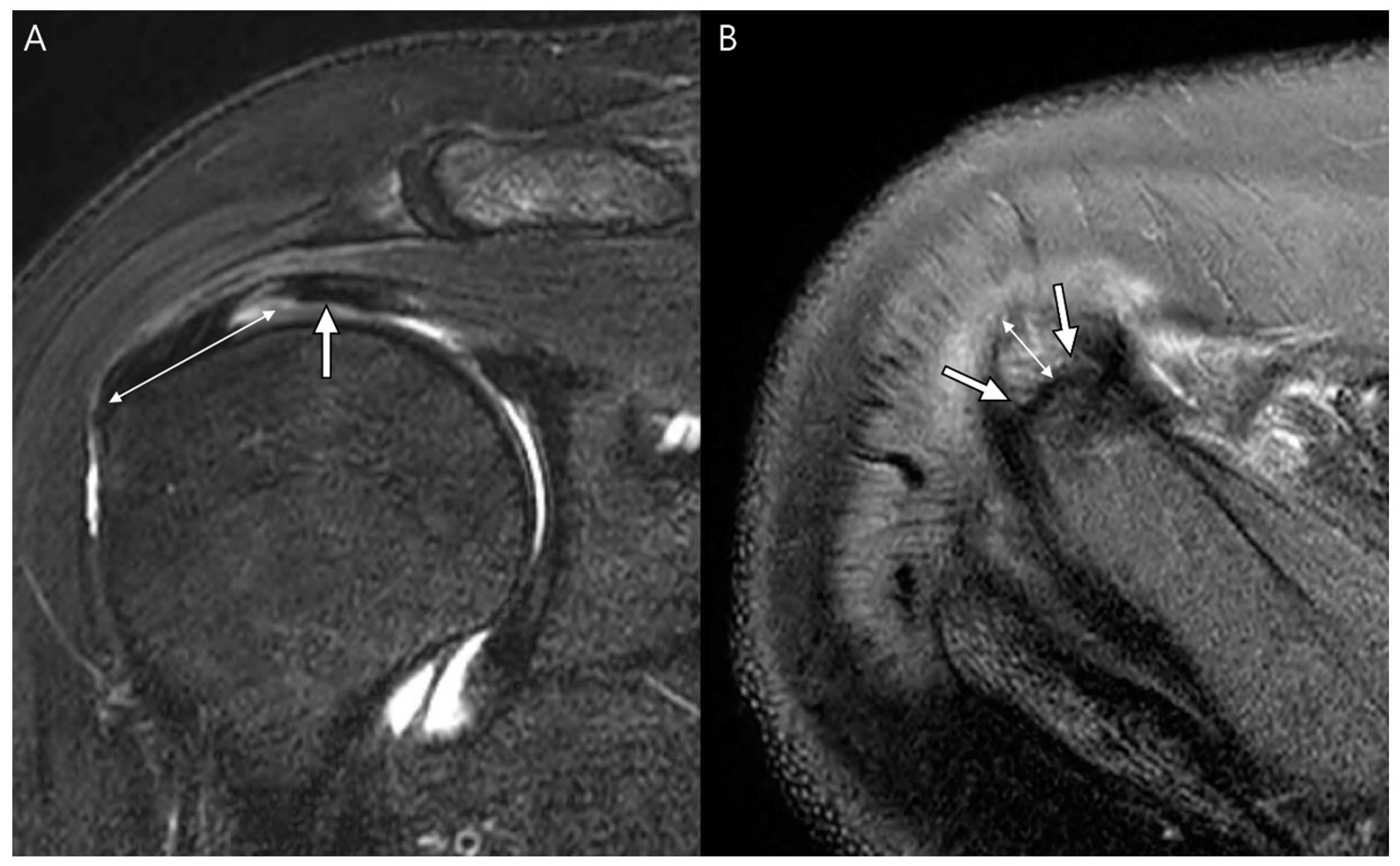 supraspinatus tear mri