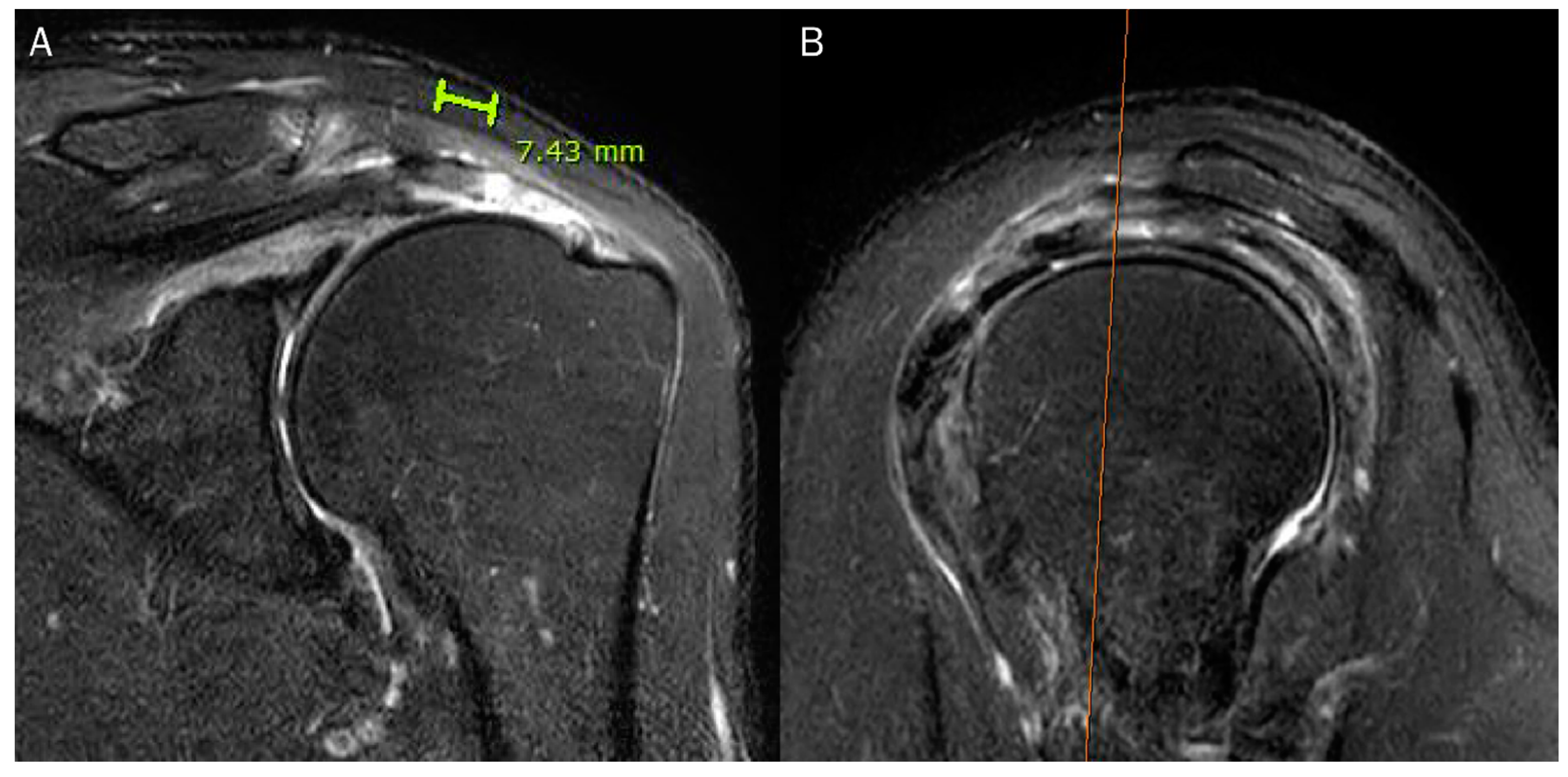 supraspinatus tear mri